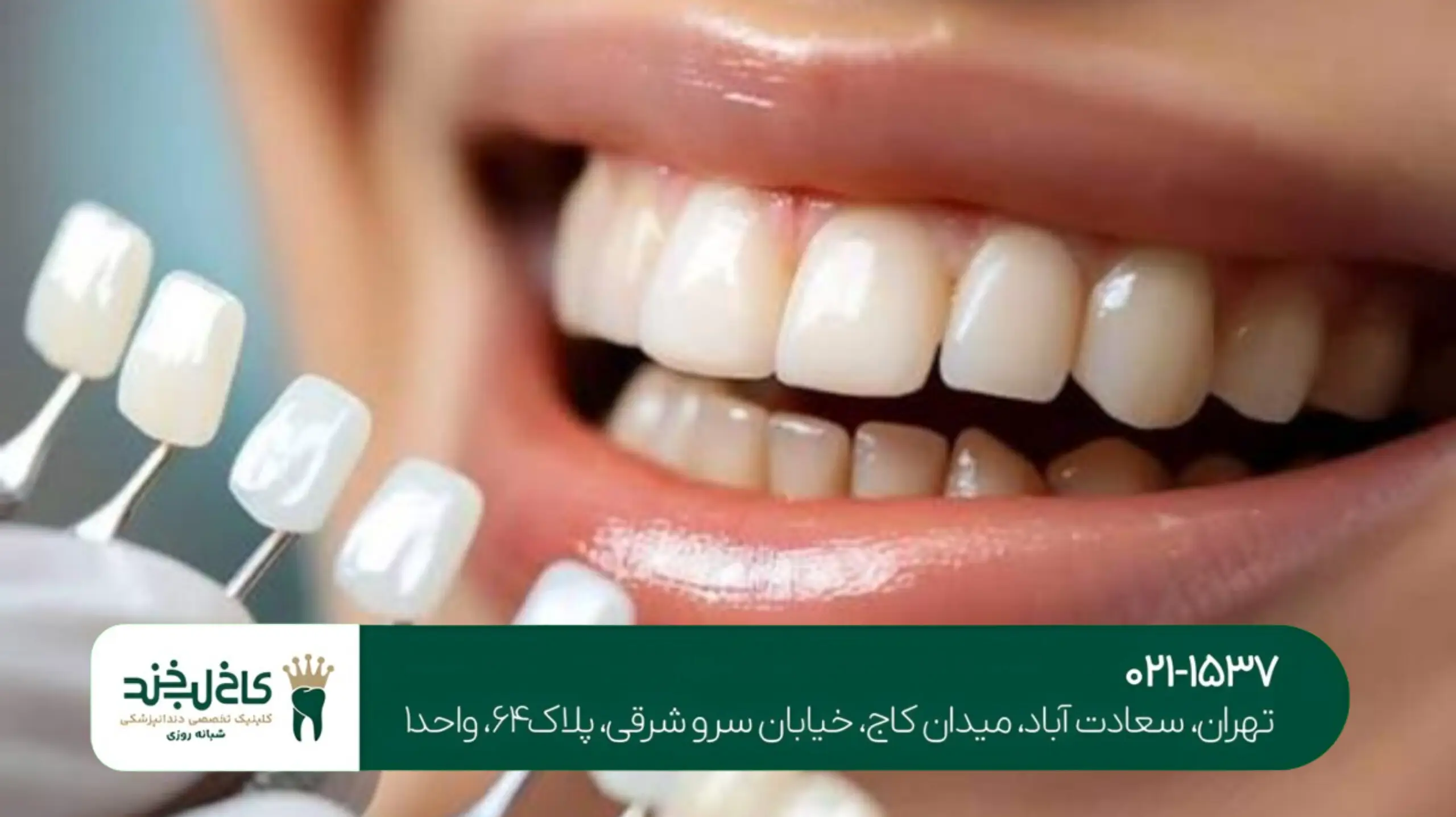 مشاوره رایگان ایمپلنت در تهران