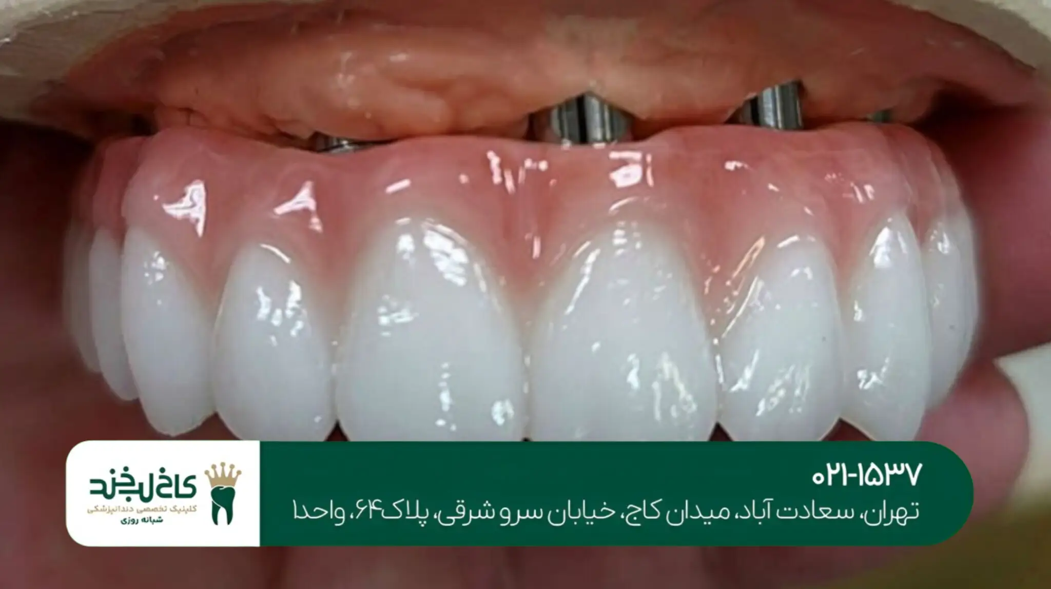 ایمپلنت دندان اقساطی در تهران