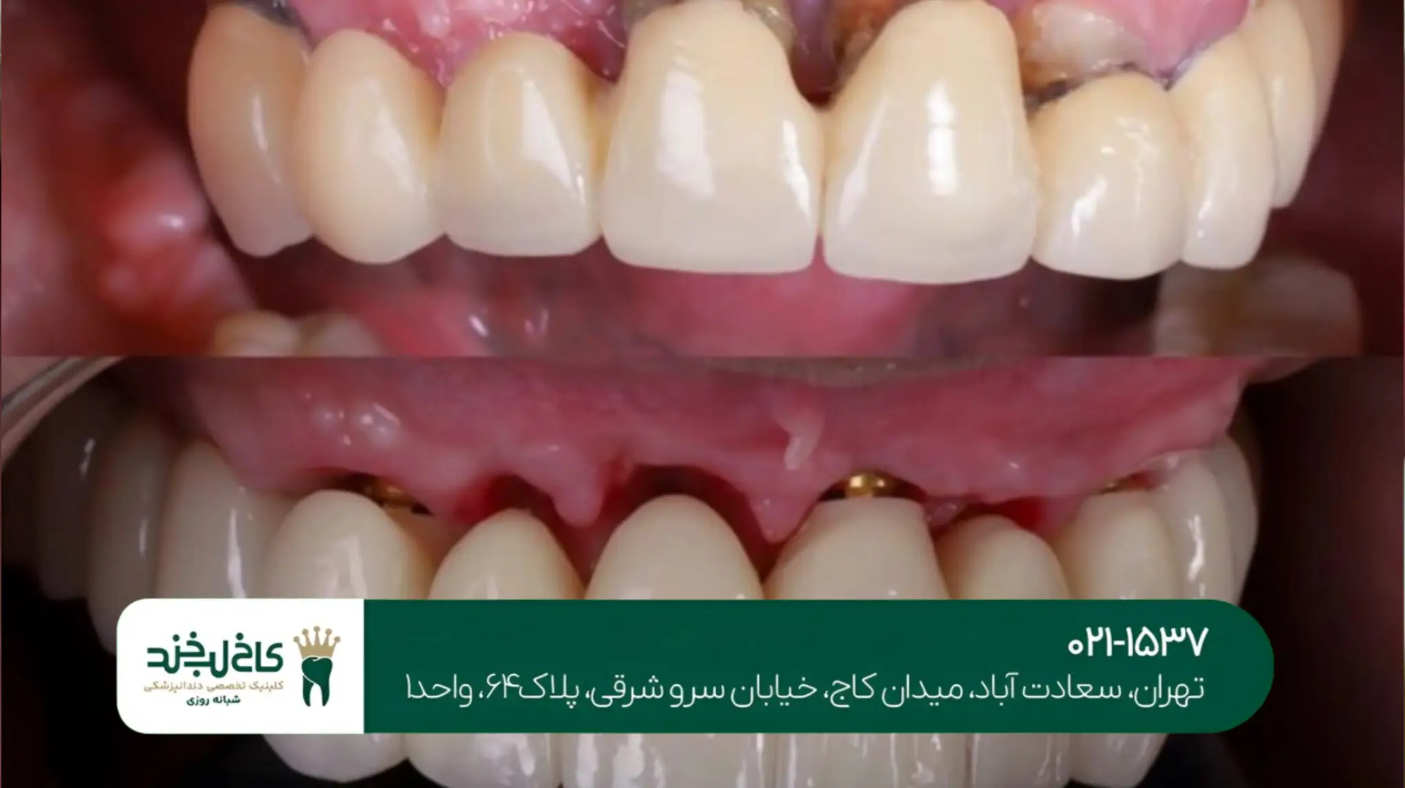 ایمپلنت دندان اقساطی در تهران