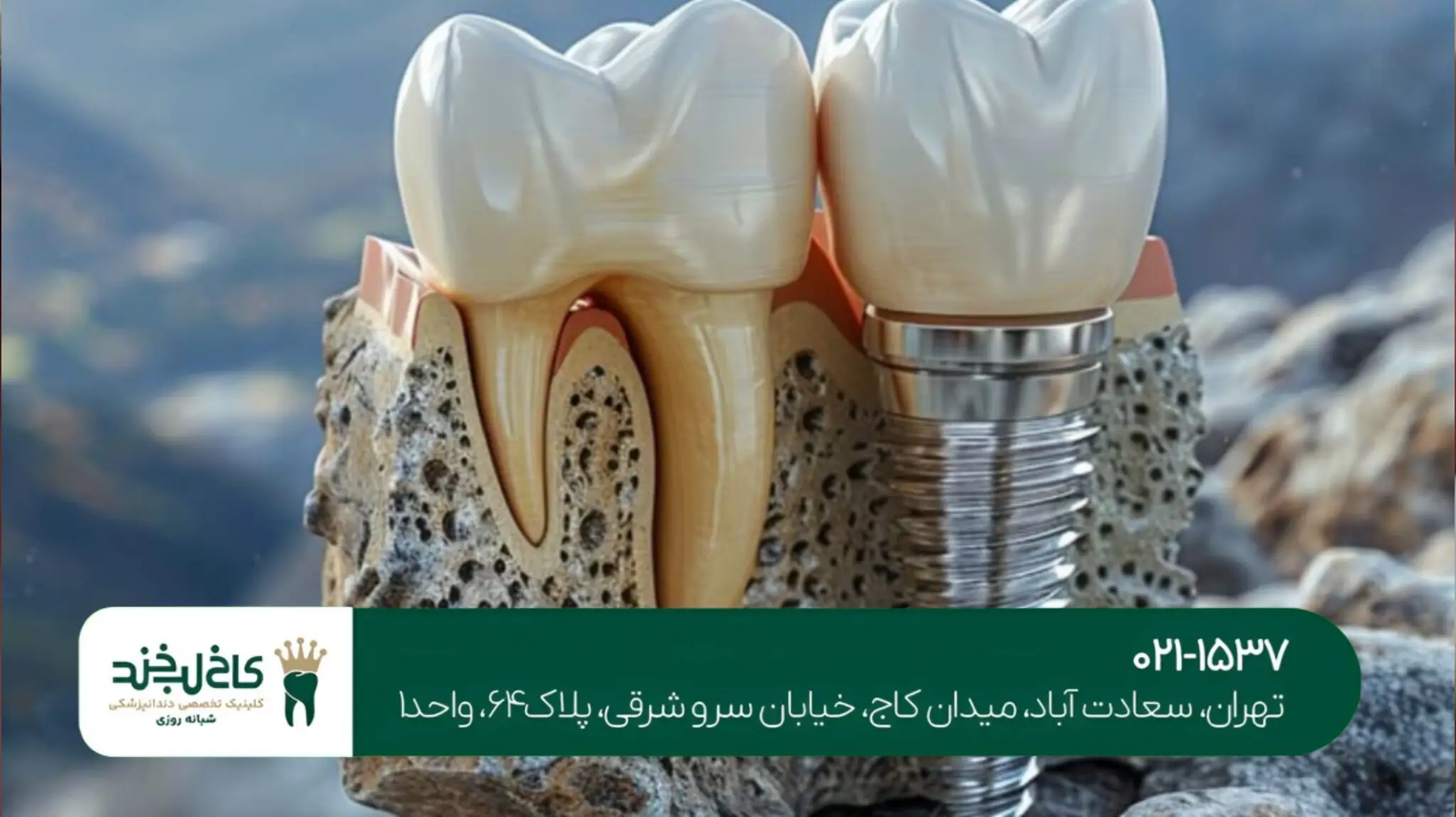 ایمپلنت دندان اقساطی در تهران