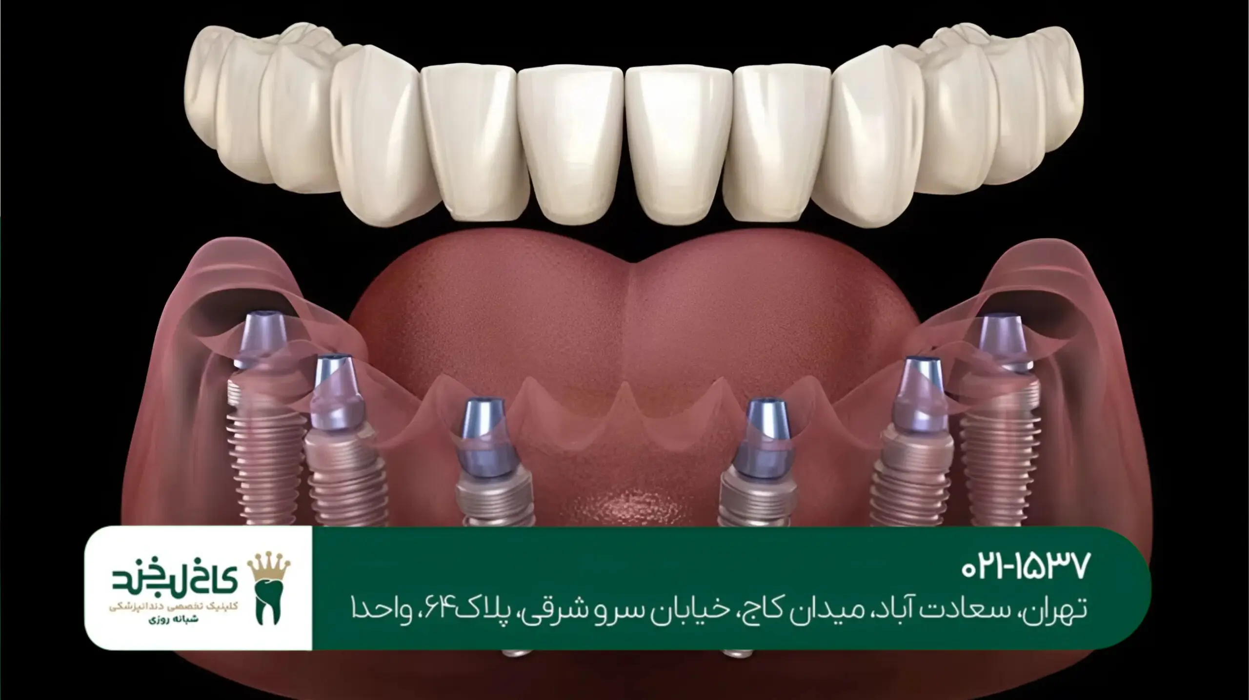 دندانپزشکی تخصصی کاشت دندان