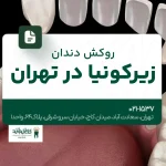 روکش دندان زیرکونیا در تهران
