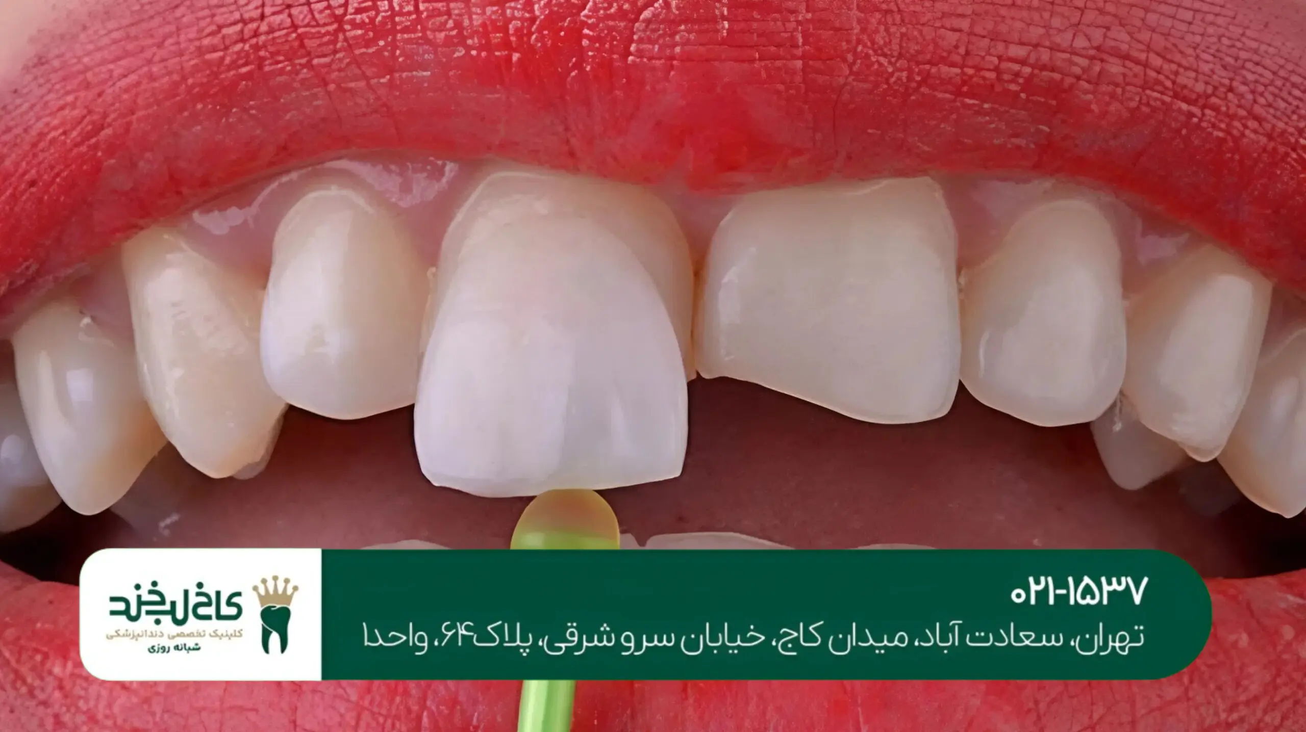 روکش دندان زیرکونیا در تهران