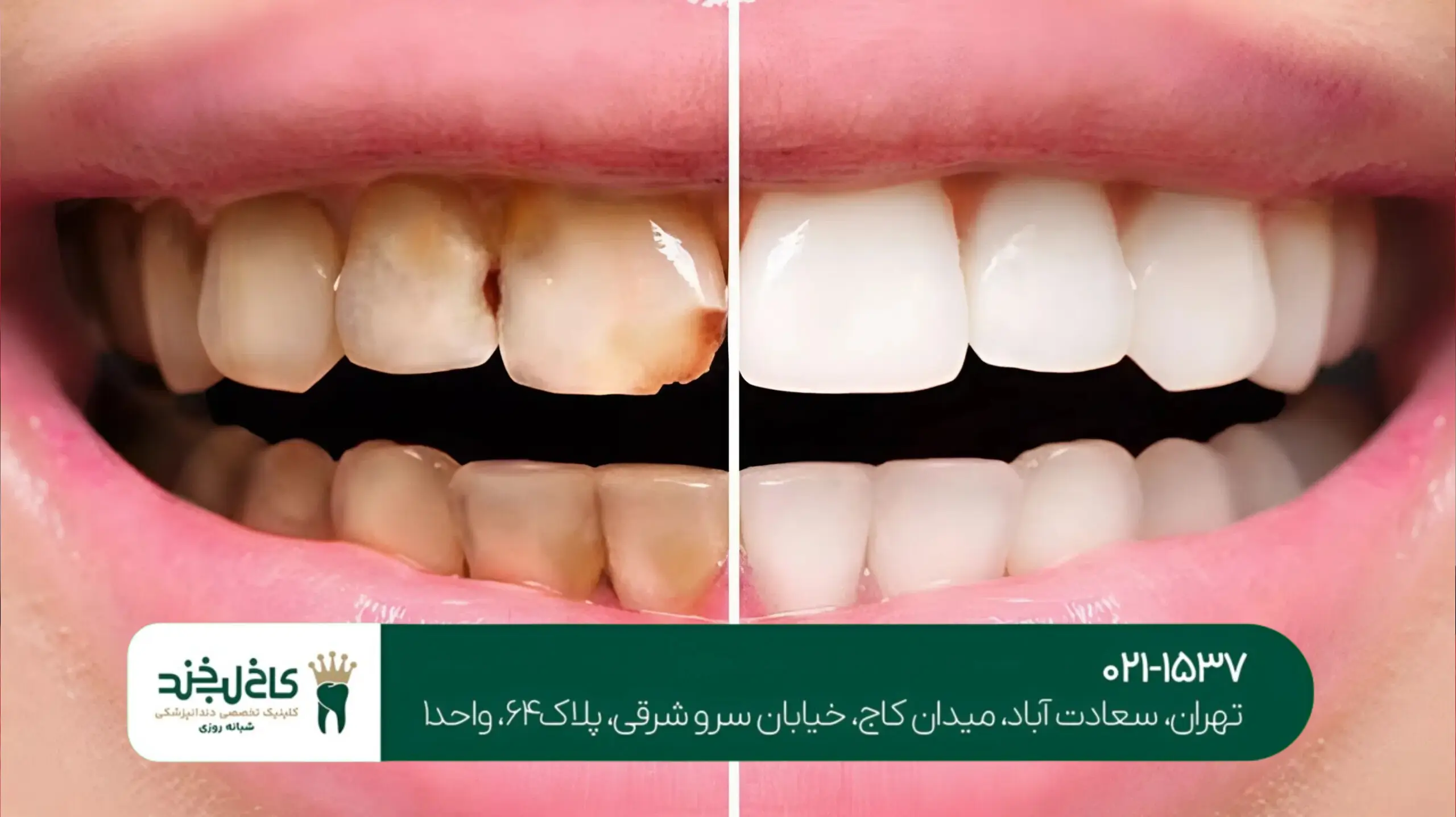 روکش دندان زیرکونیا در تهران