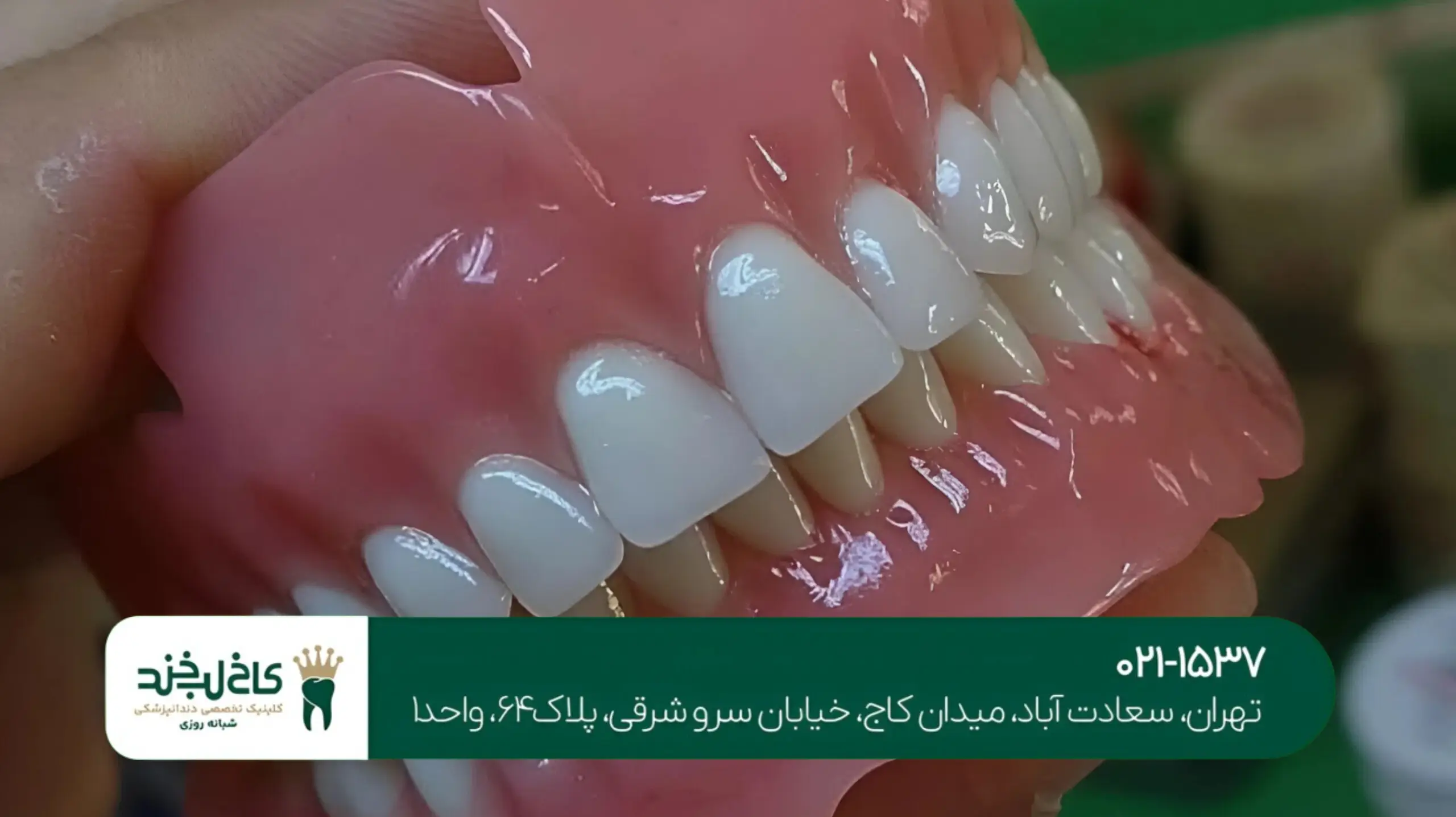 روکش دندان زیرکونیا در تهران