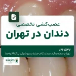 عصب‌کشی تخصصی دندان در تهران