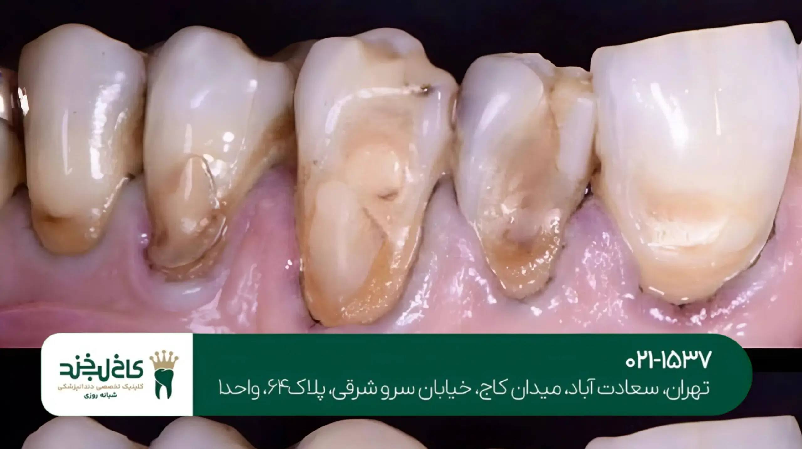 عصب‌کشی تخصصی دندان در تهران