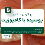 پر کردن دندان پوسیده با کامپوزیت