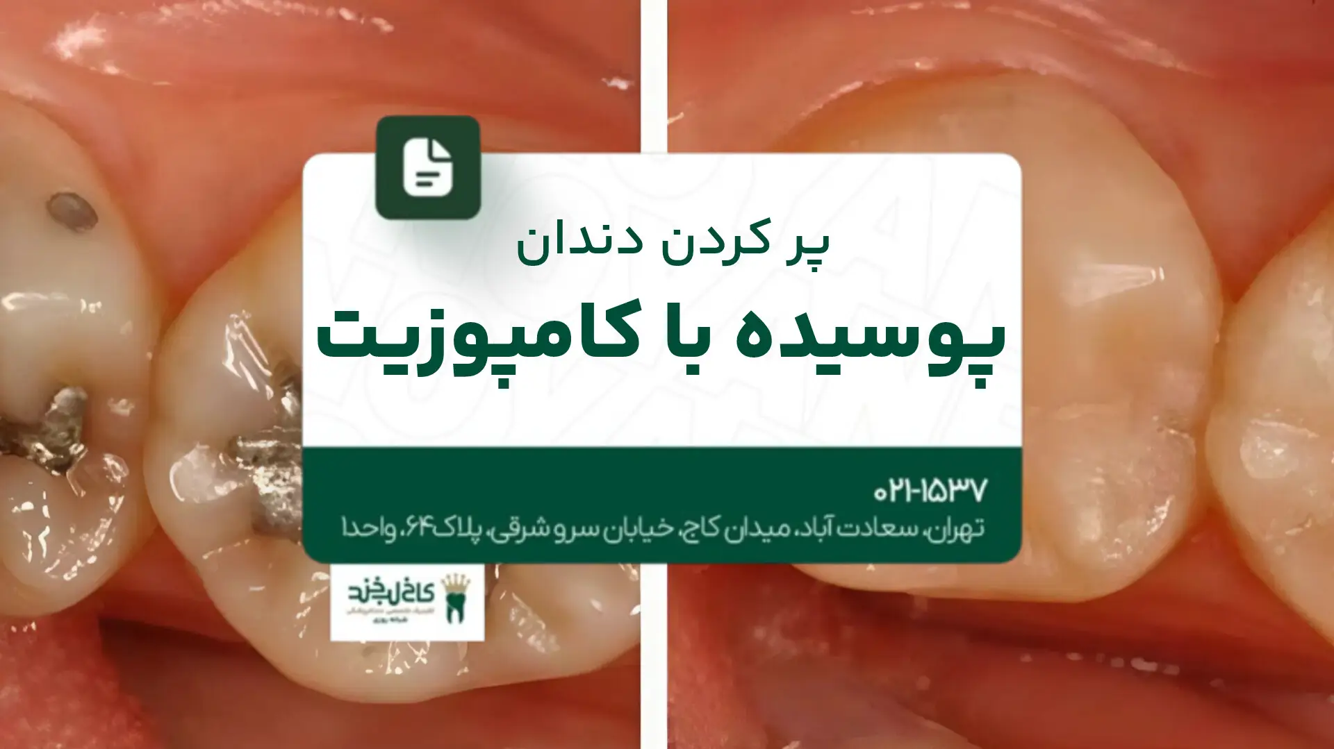 پر کردن دندان پوسیده با کامپوزیت