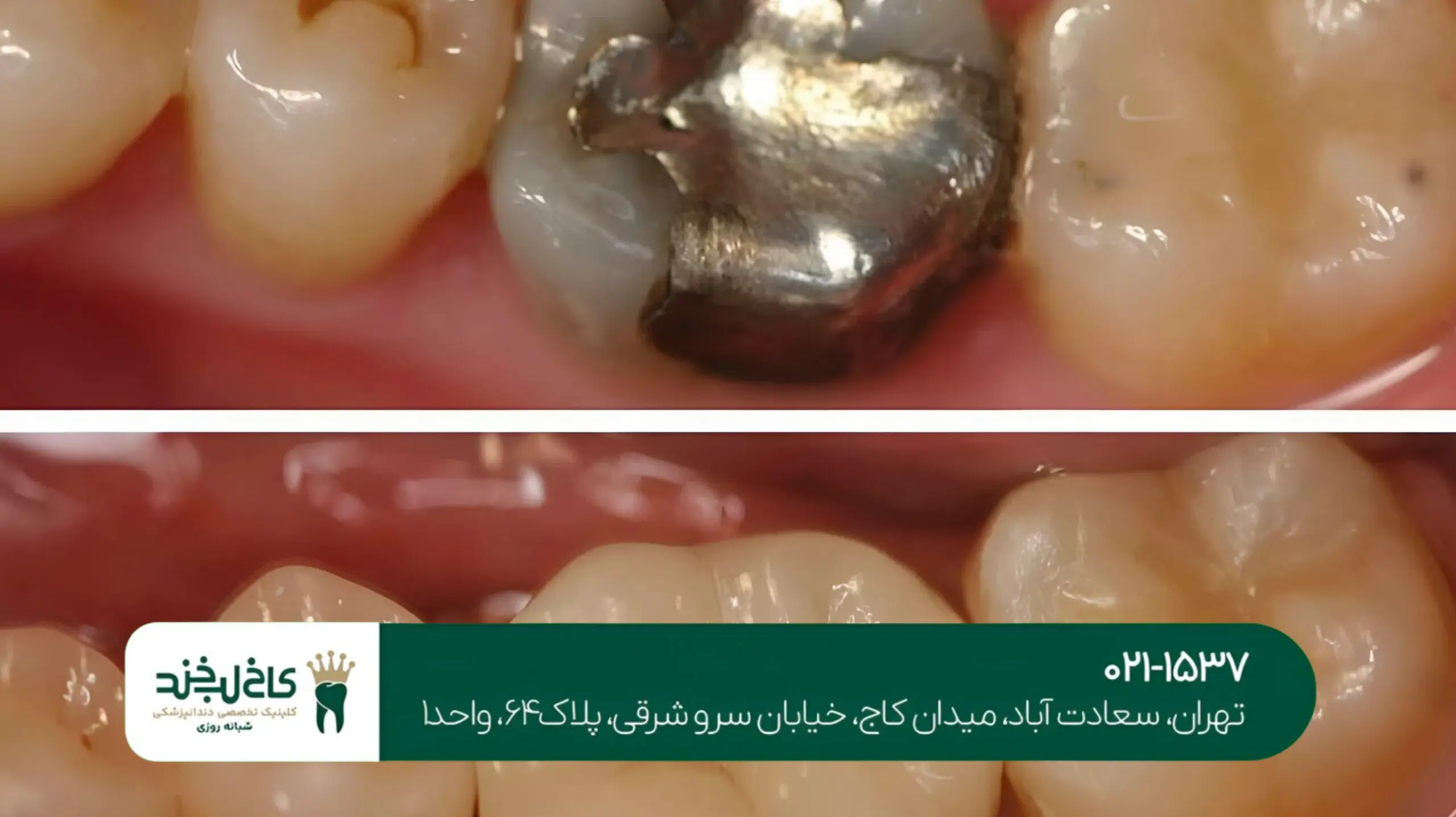 پر کردن دندان پوسیده با کامپوزیت