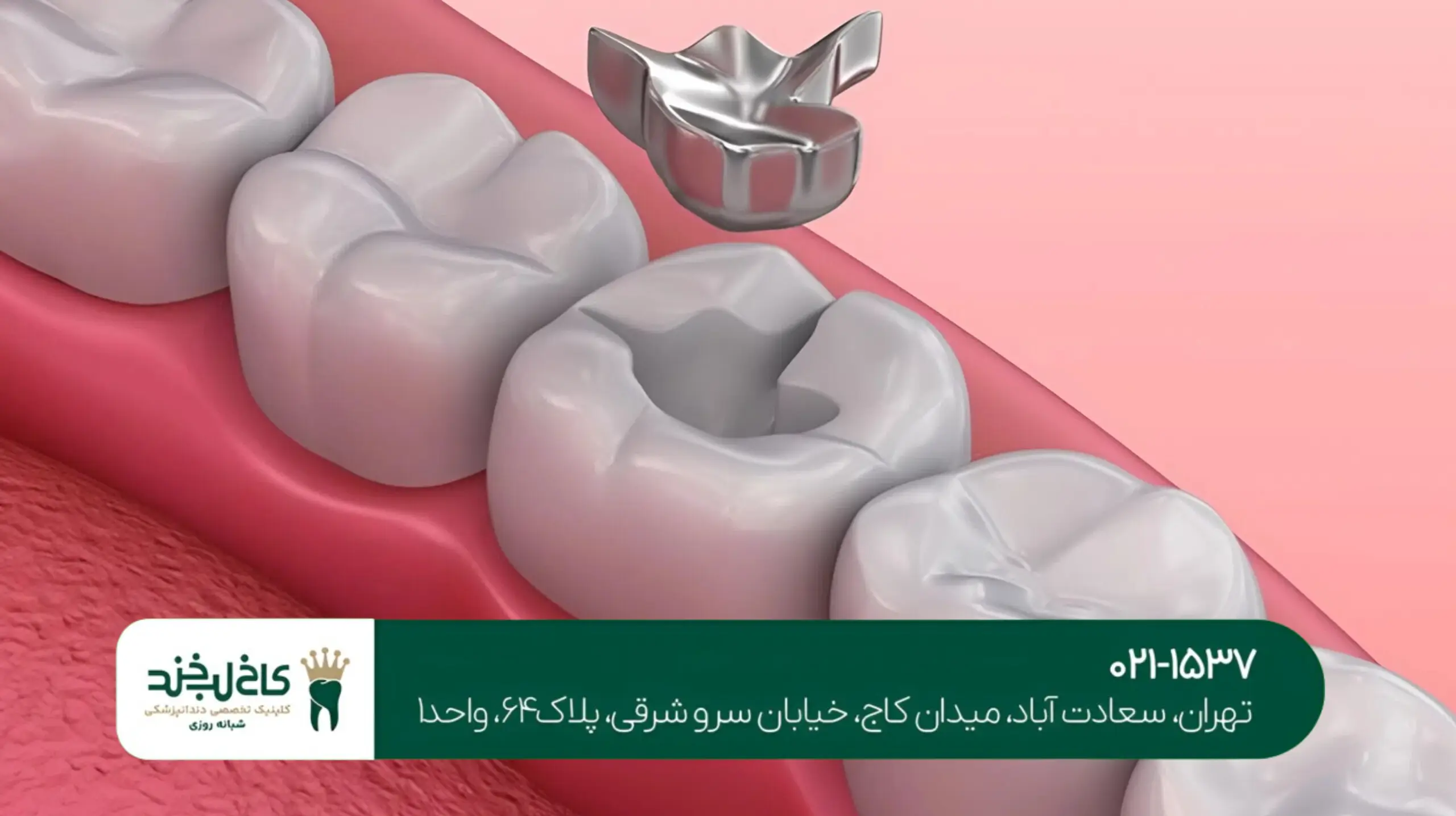پر کردن دندان پوسیده با کامپوزیت