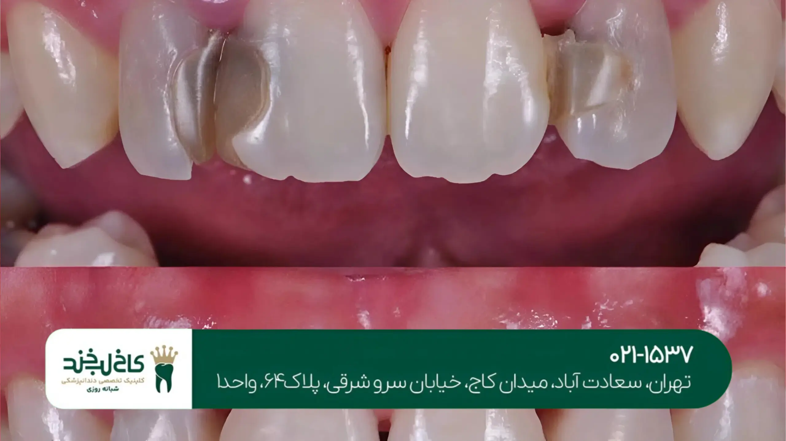 پر کردن دندان پوسیده با کامپوزیت