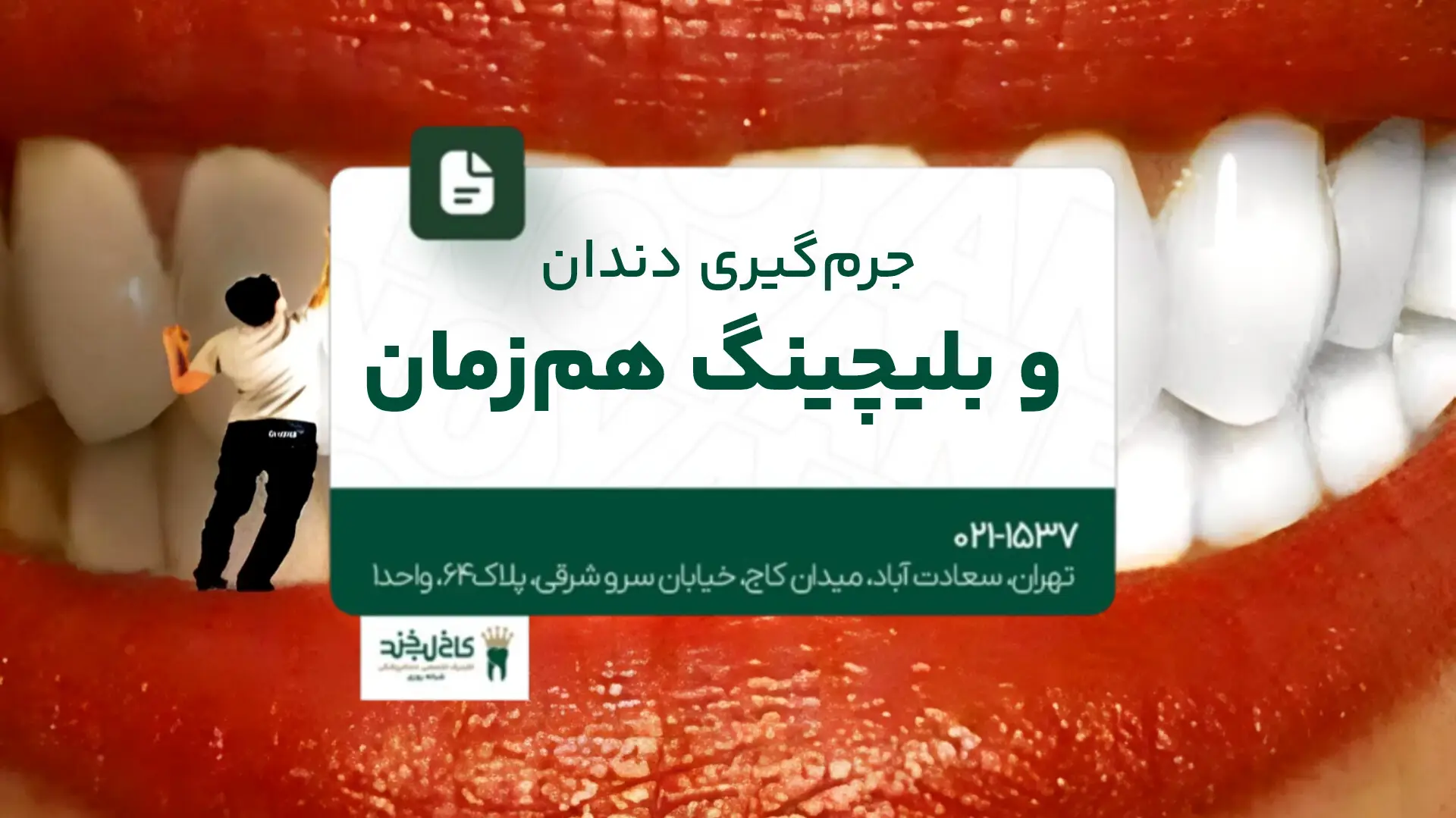 جرم‌گیری دندان و بلیچینگ هم‌زمان