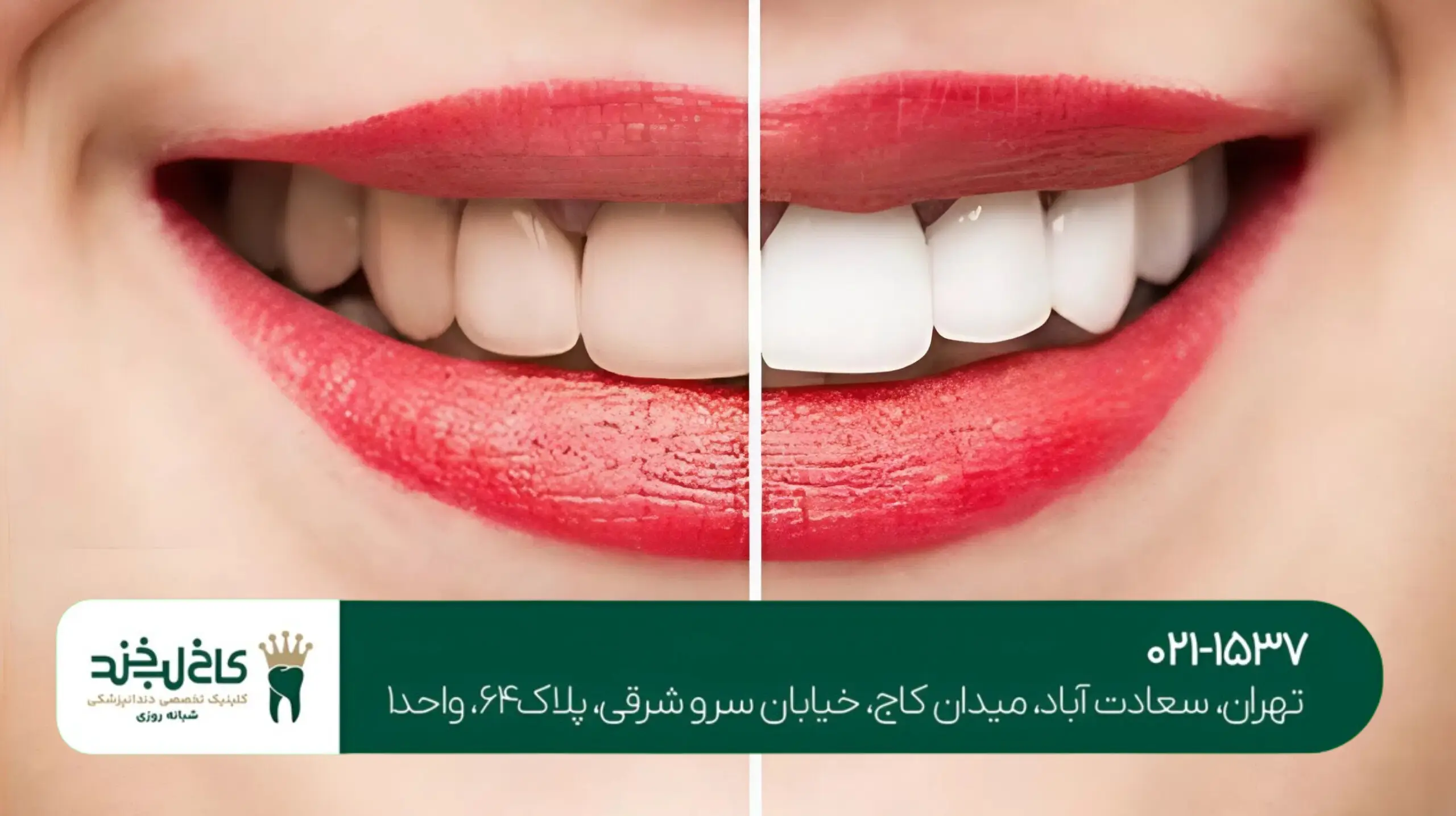 جرم‌گیری دندان و بلیچینگ هم‌زمان