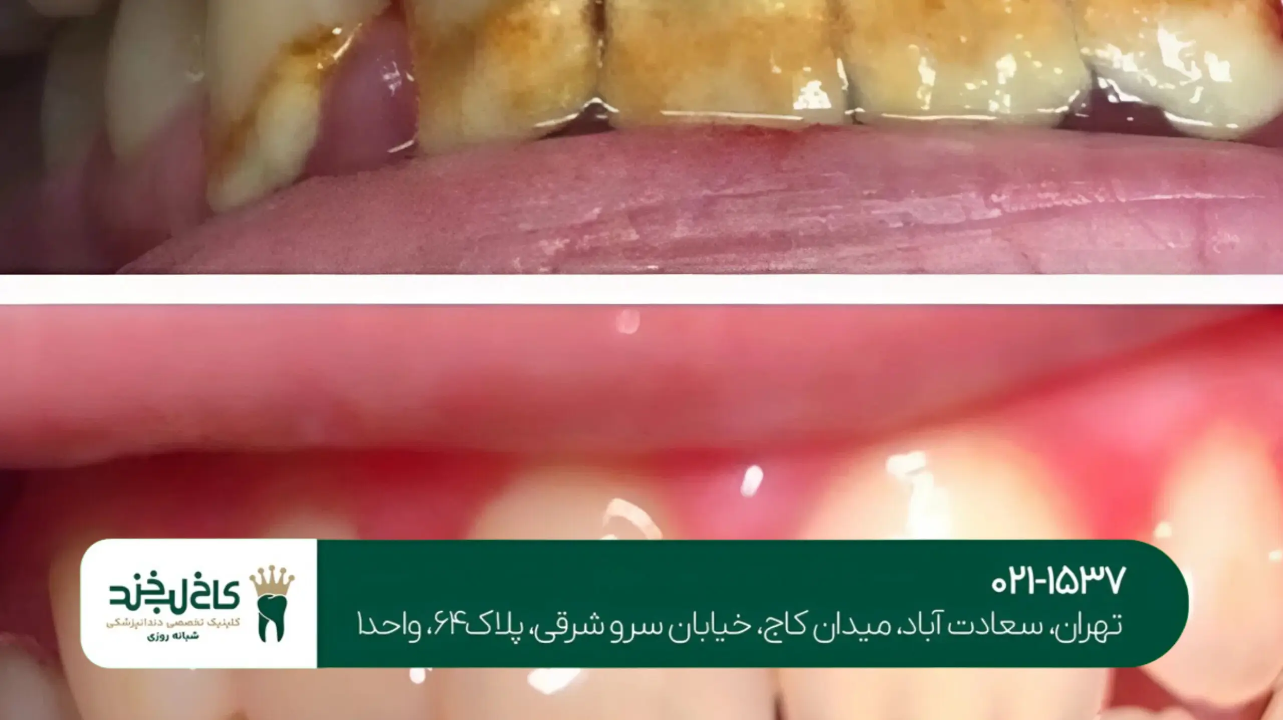 جرم‌گیری دندان و بلیچینگ هم‌زمان