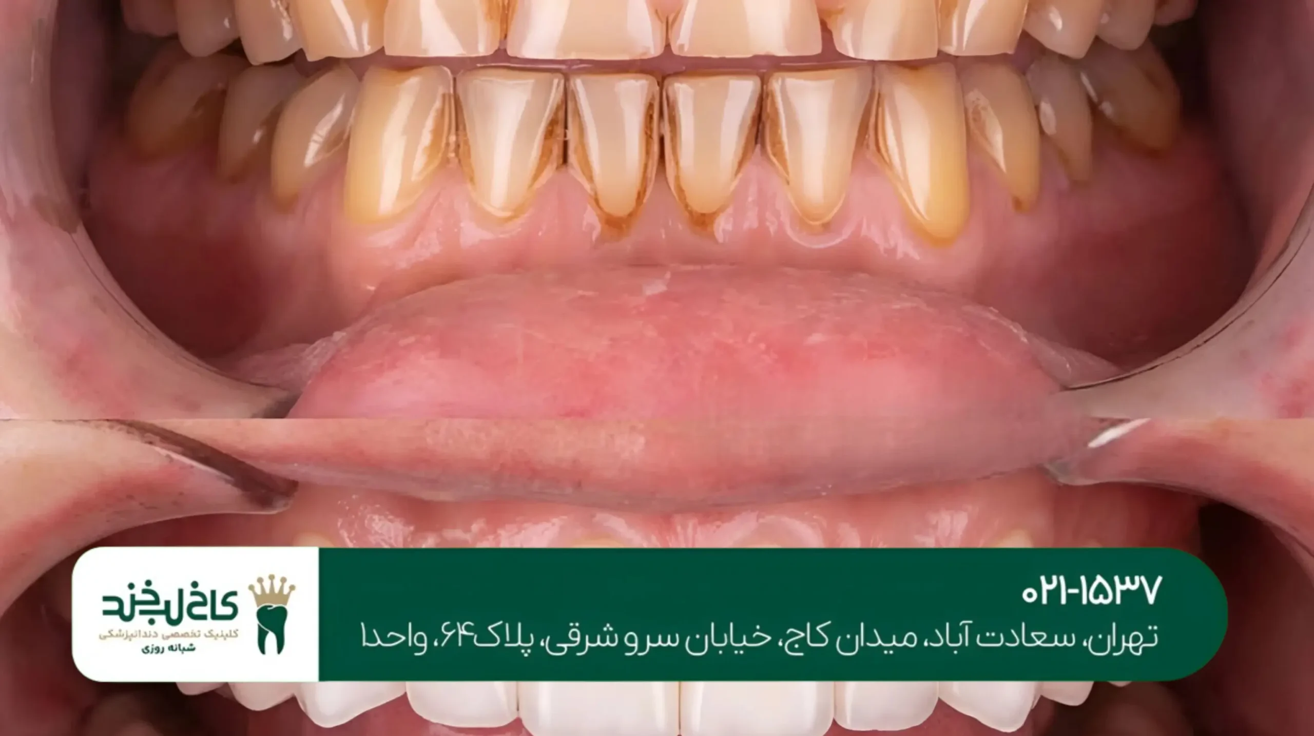 جرم‌گیری دندان و بلیچینگ هم‌زمان