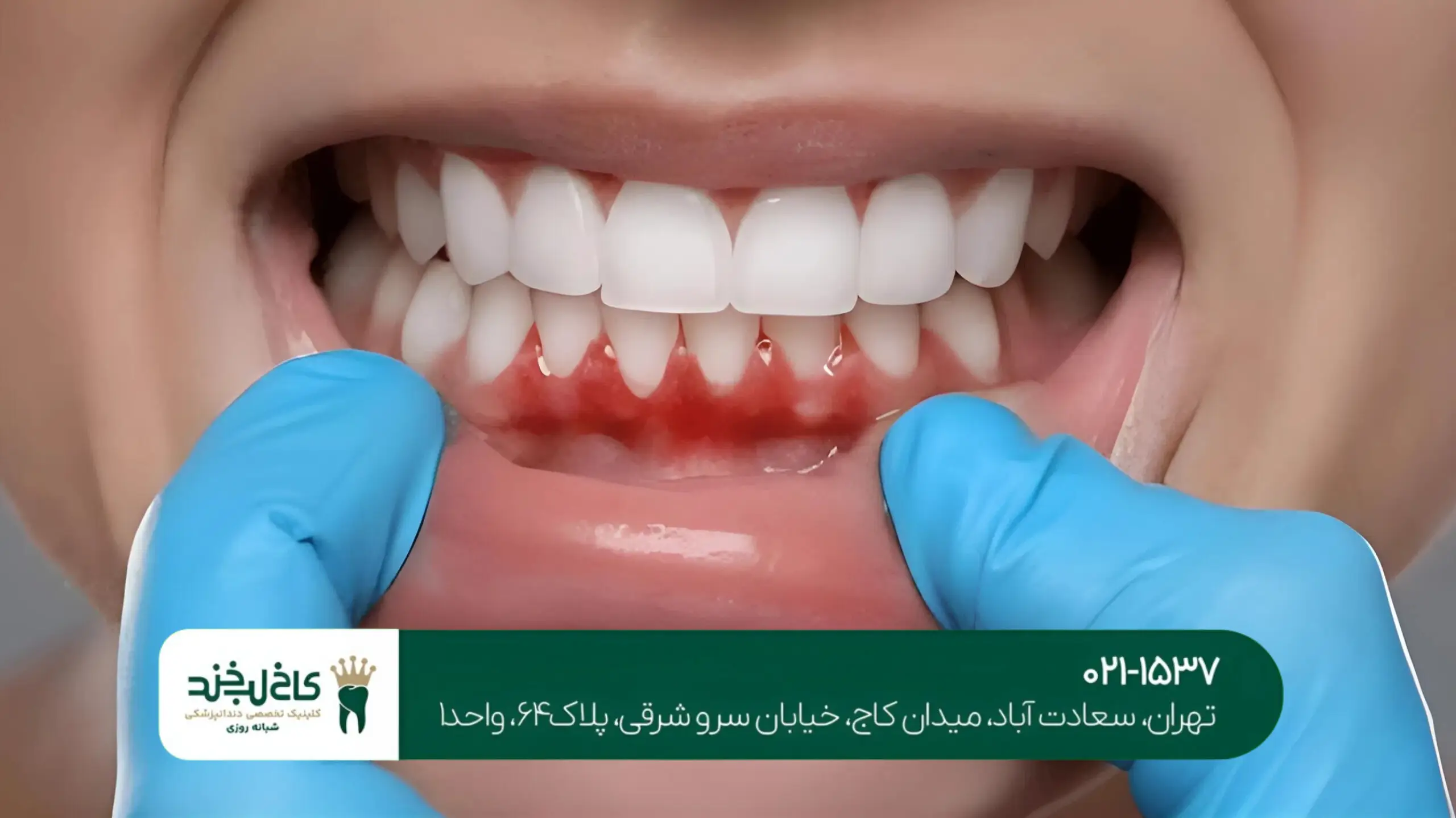 درمان لثه های تحلیل رفته