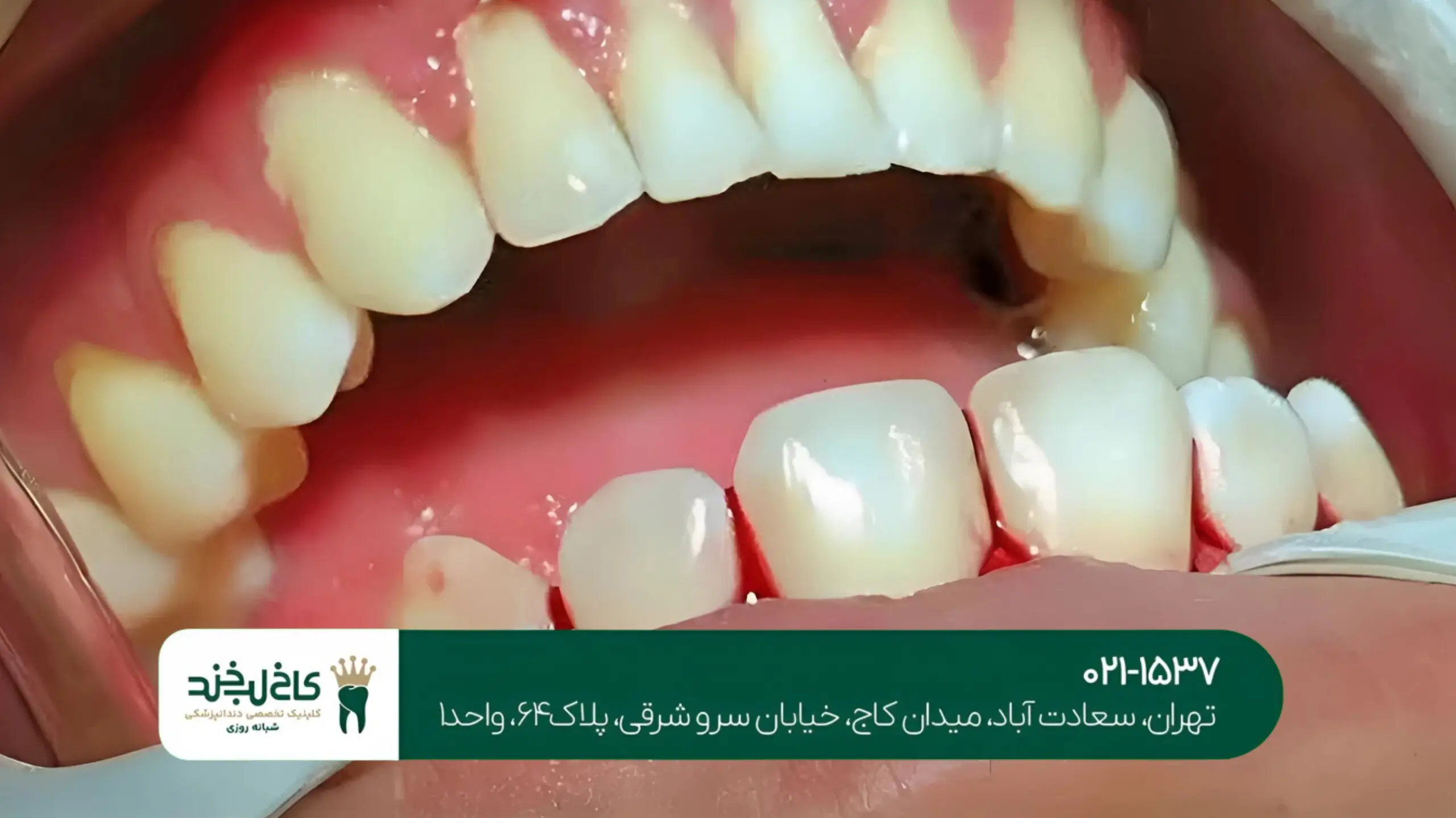 درمان لثه های تحلیل رفته