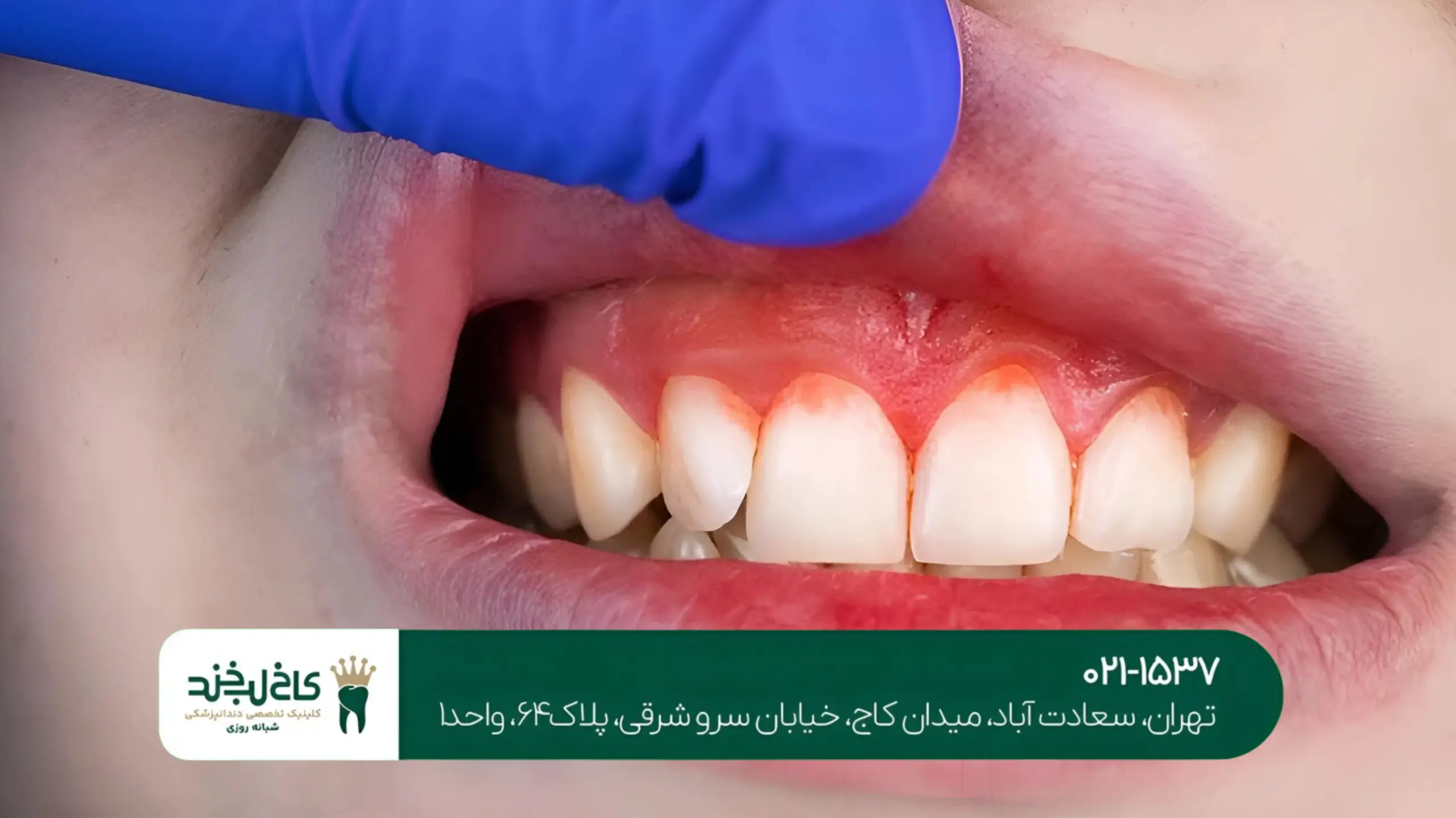درمان لثه های تحلیل رفته