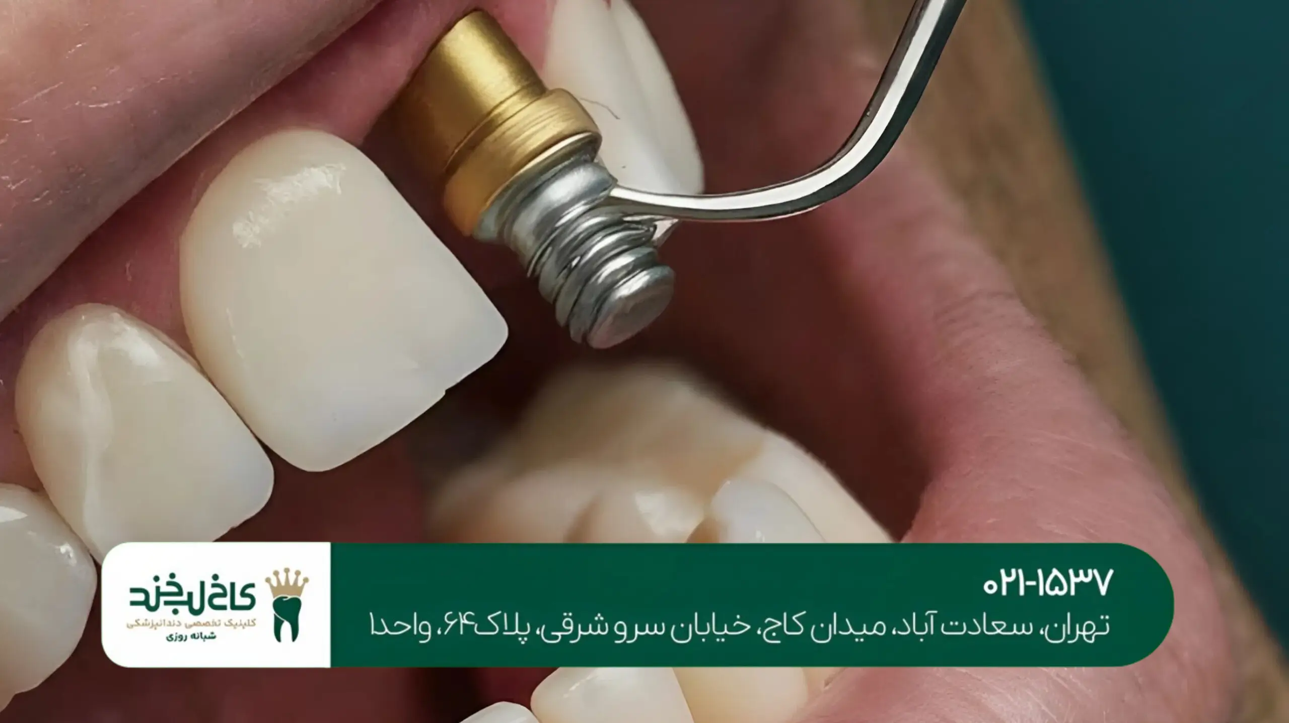 ایمپلنت یک روزه در تهران