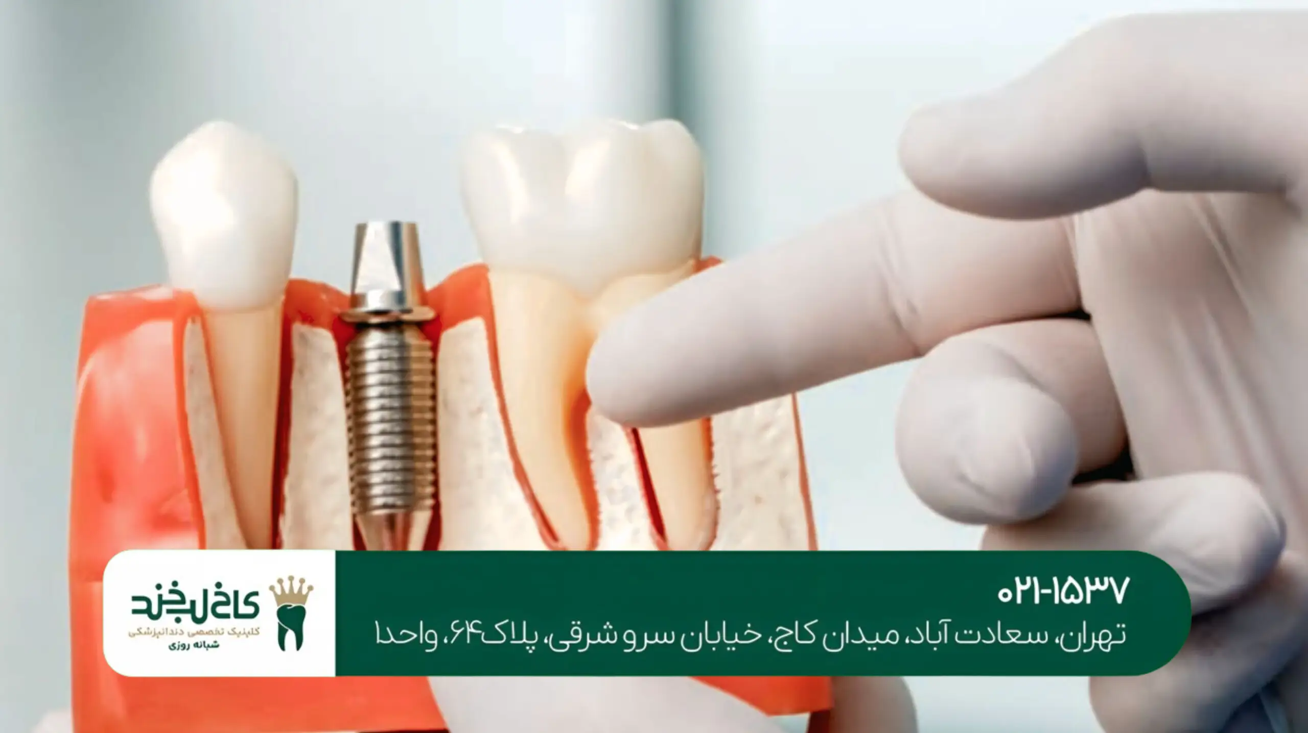 ایمپلنت یک روزه در تهران