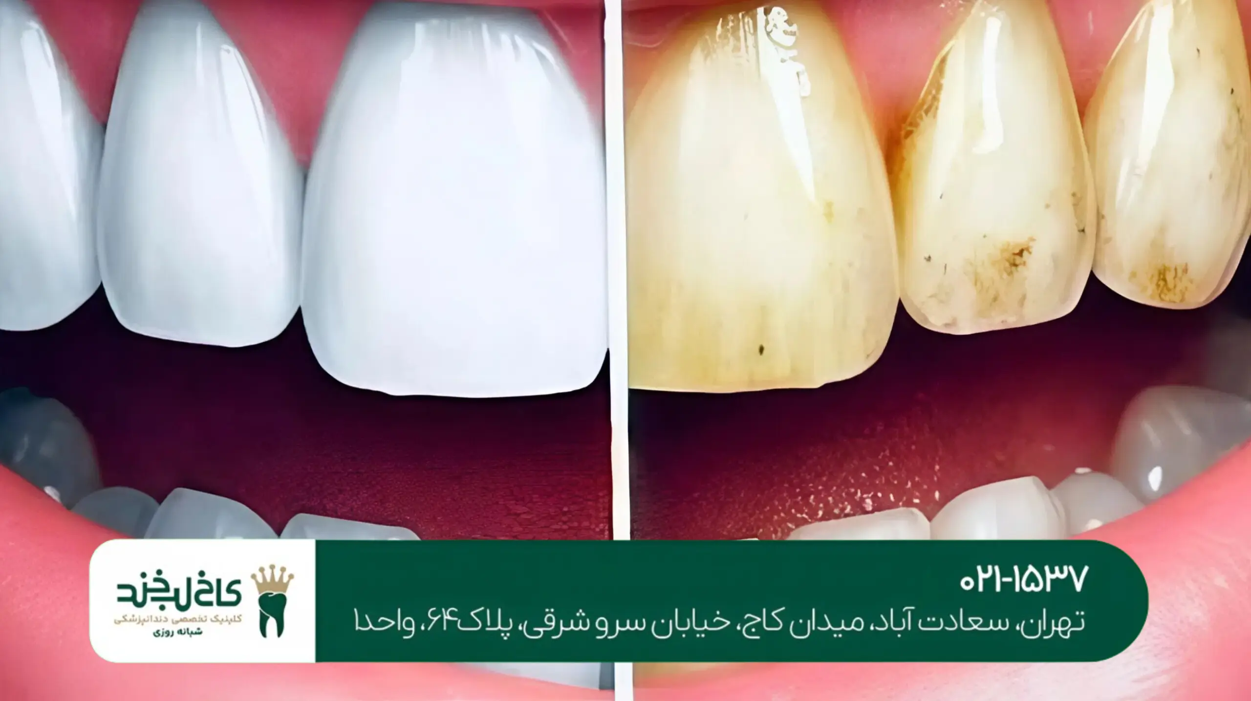 بهترین متخصص لمینت سرامیکی