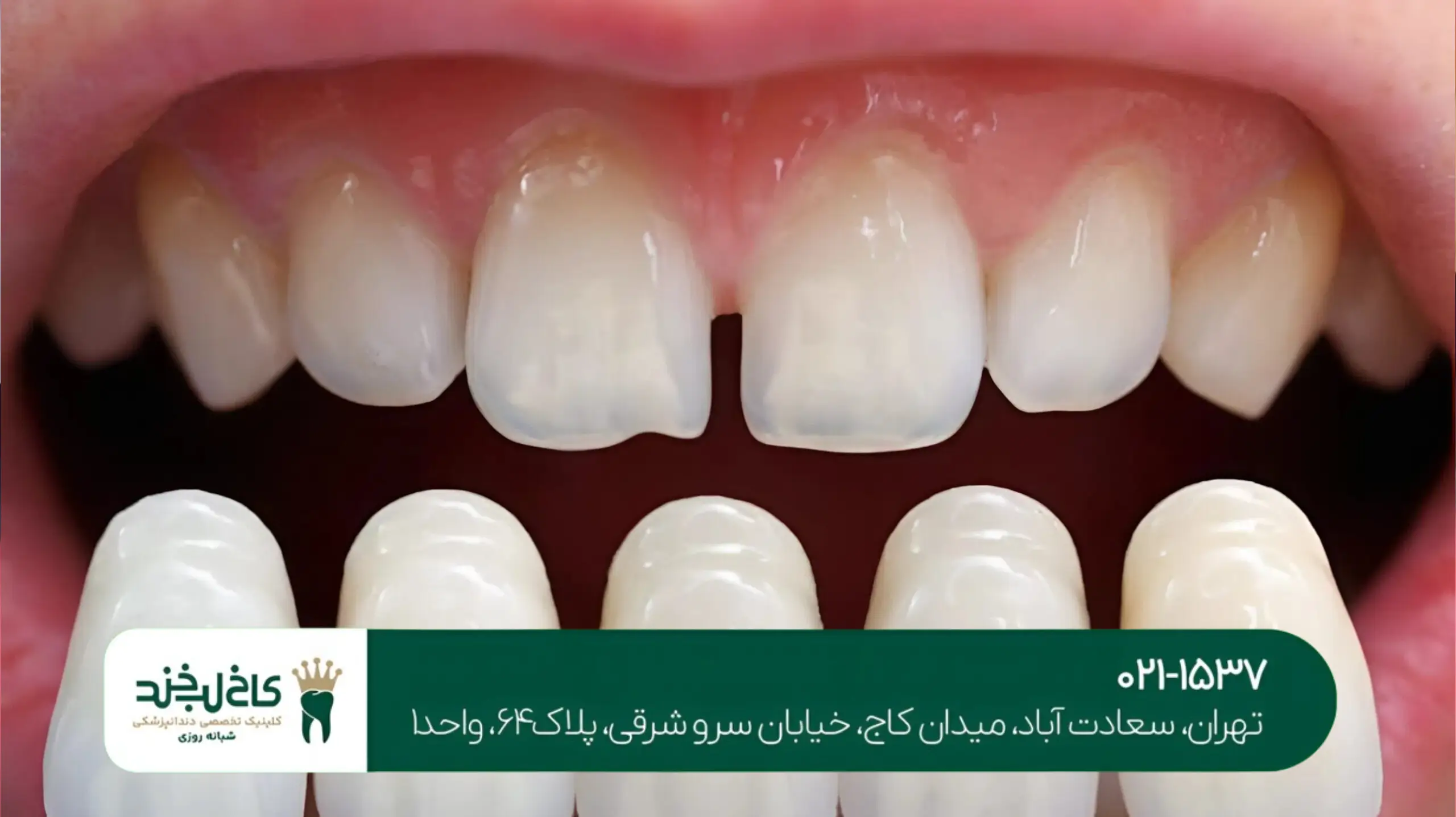 رفع تیرگی دندان با سفیدکننده لیزری