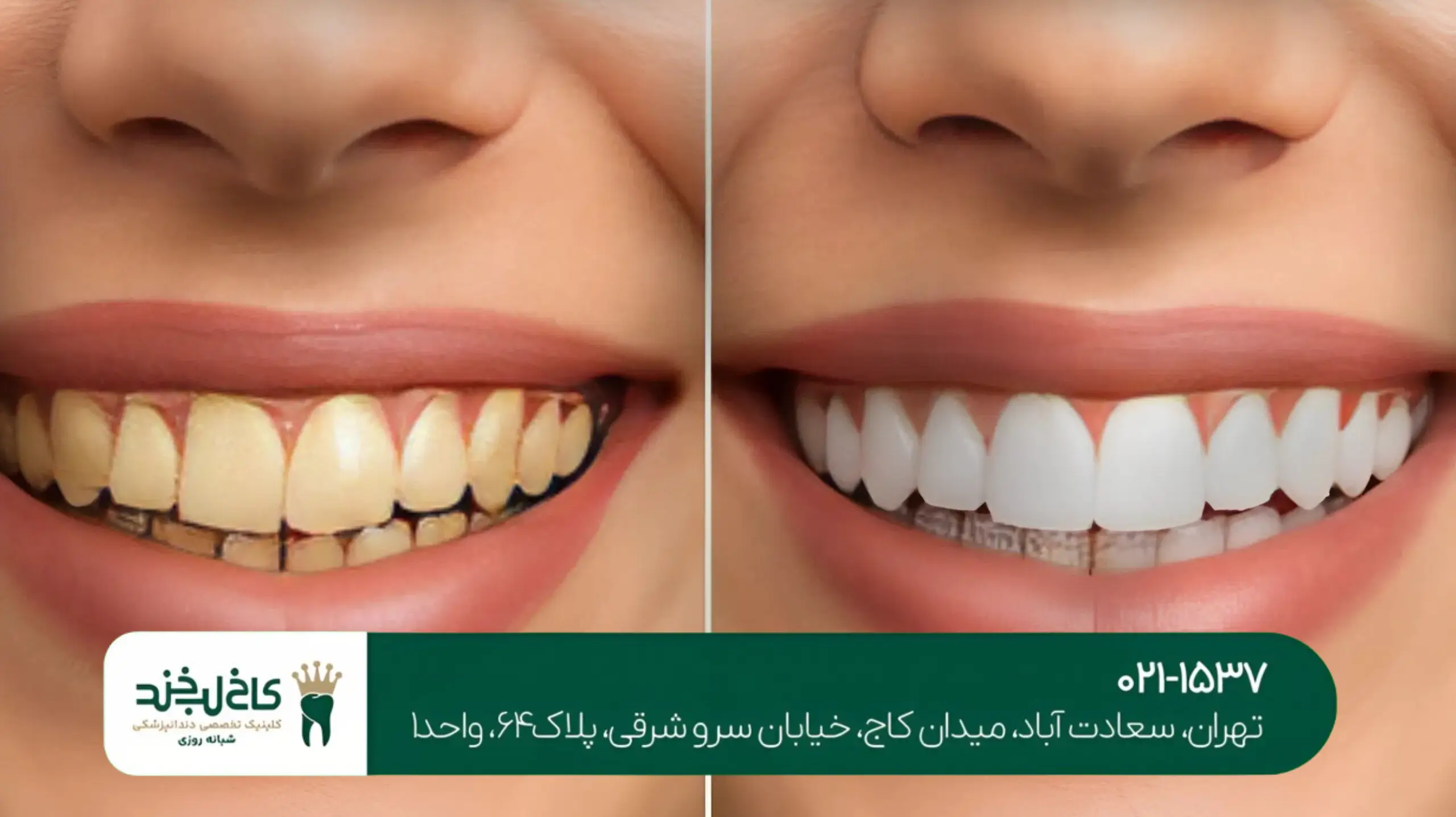 بهترین متخصص لمینت سرامیکی