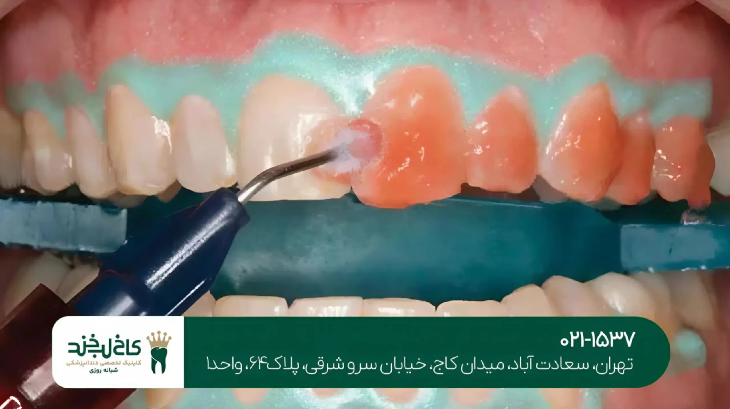 بهترین متخصص لمینت سرامیکی