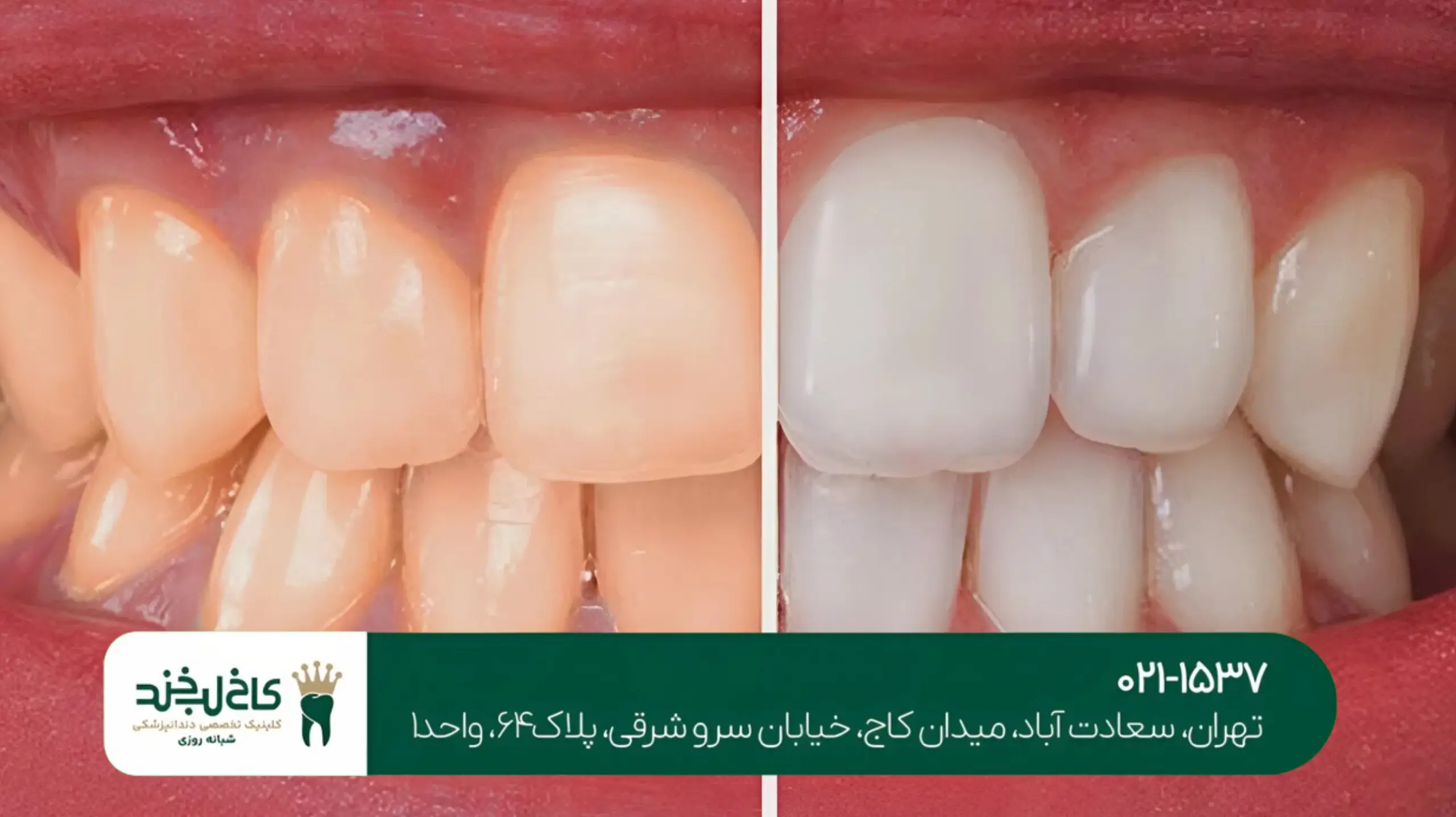 رفع تیرگی دندان با سفیدکننده لیزری