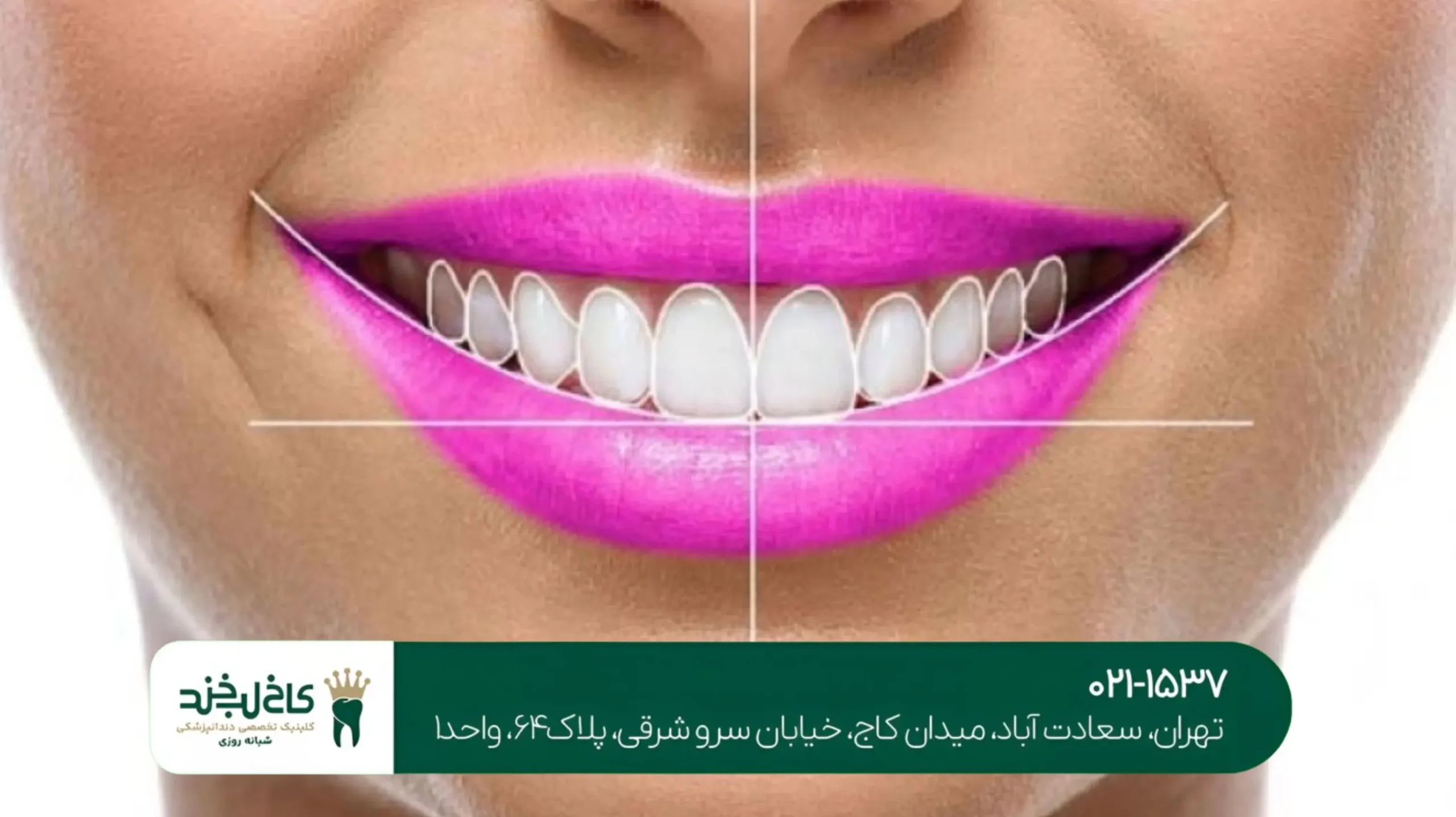 طراحی دیجیتال لبخند در تهران