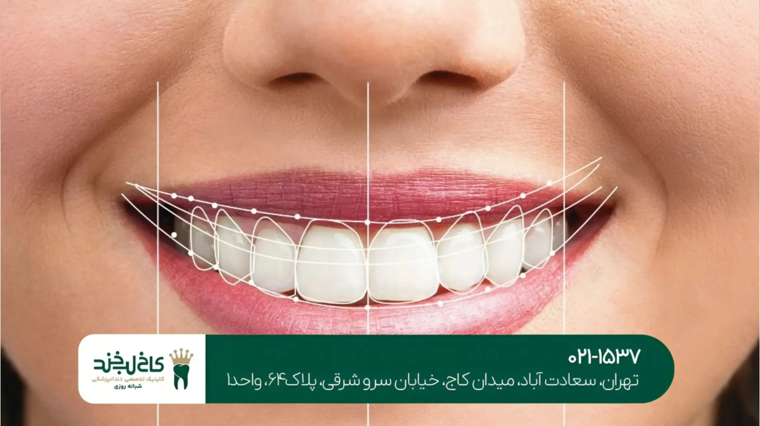 رفع تیرگی دندان با سفیدکننده لیزری