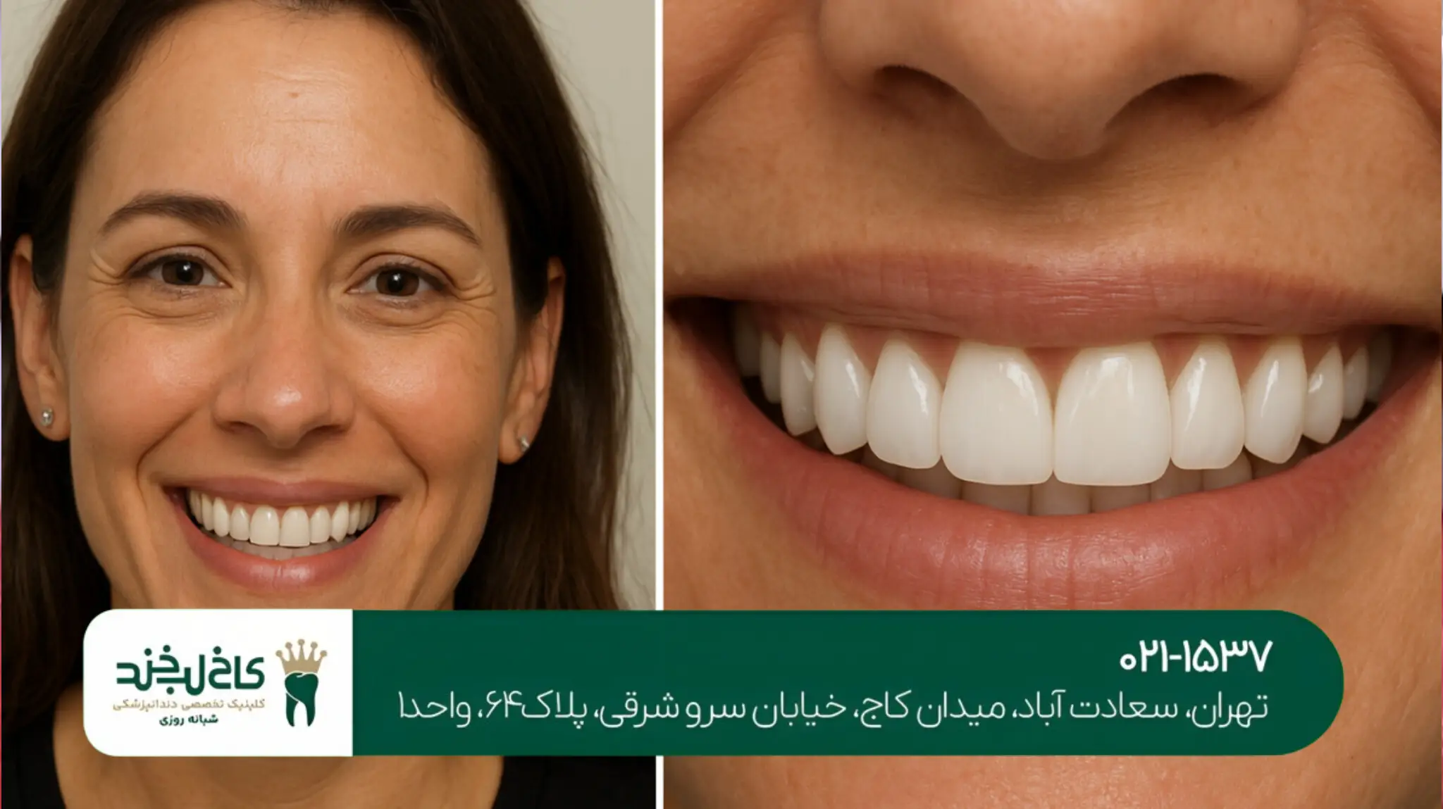 لمینت دندان بدون تراش