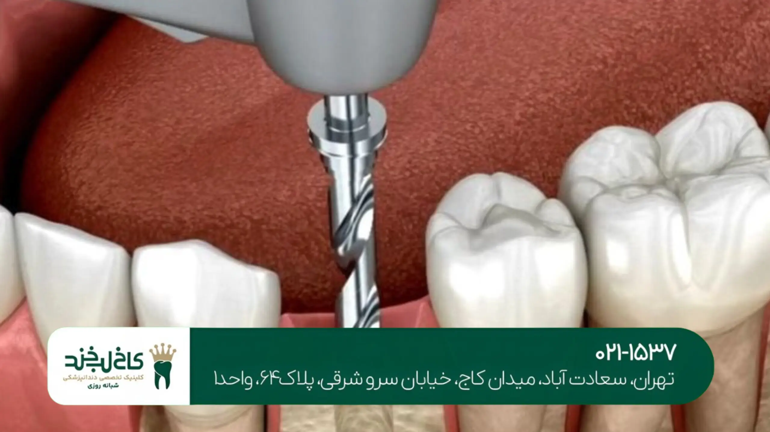 کاشت ایمپلنت فوری