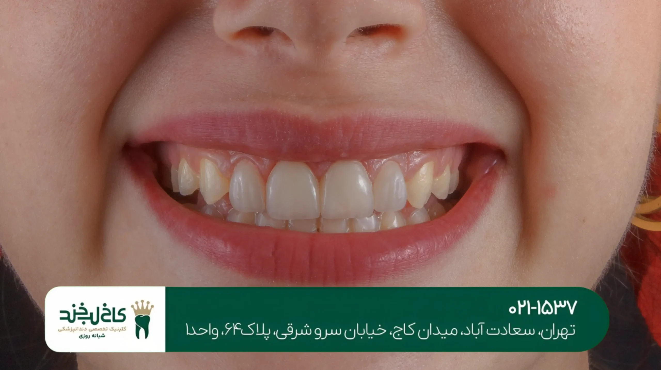 جراحی لثه برای اصلاح طرح لبخند