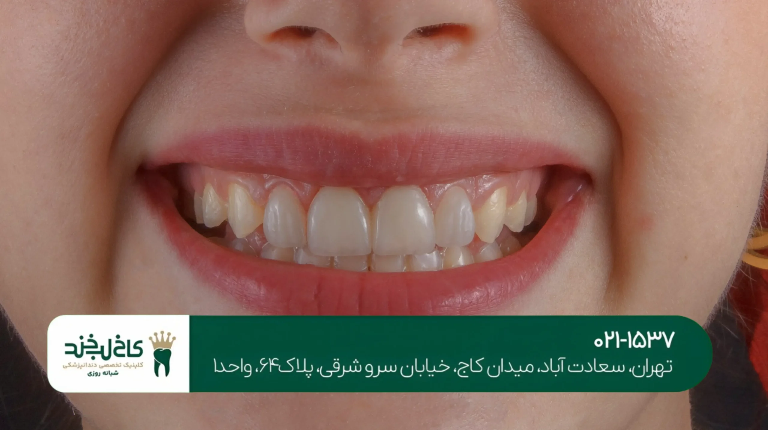 بهترین مرکز سفیدکردن دندان در تهران