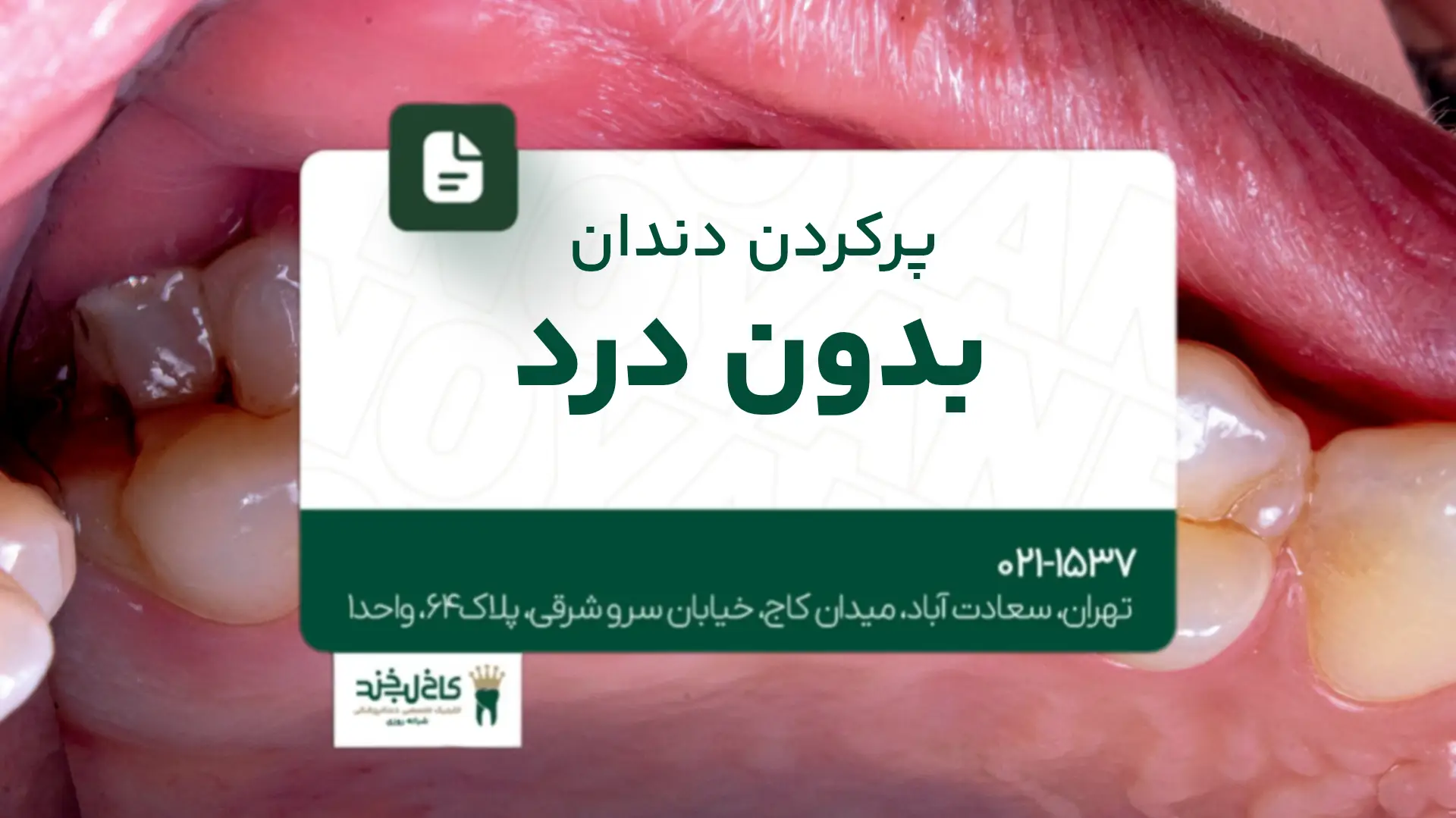 پرکردن دندان بدون درد