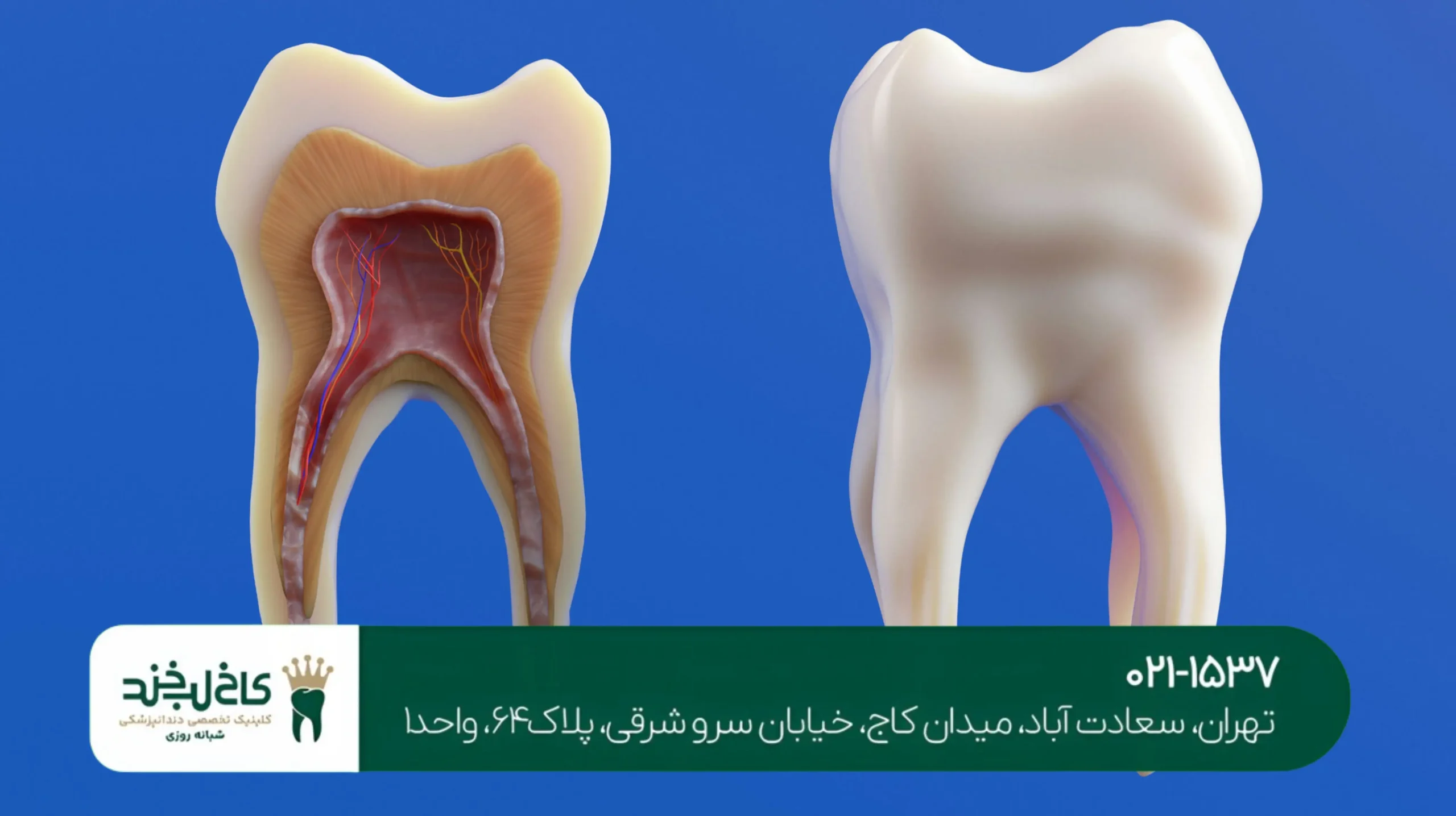 پرکردن دندان بدون درد