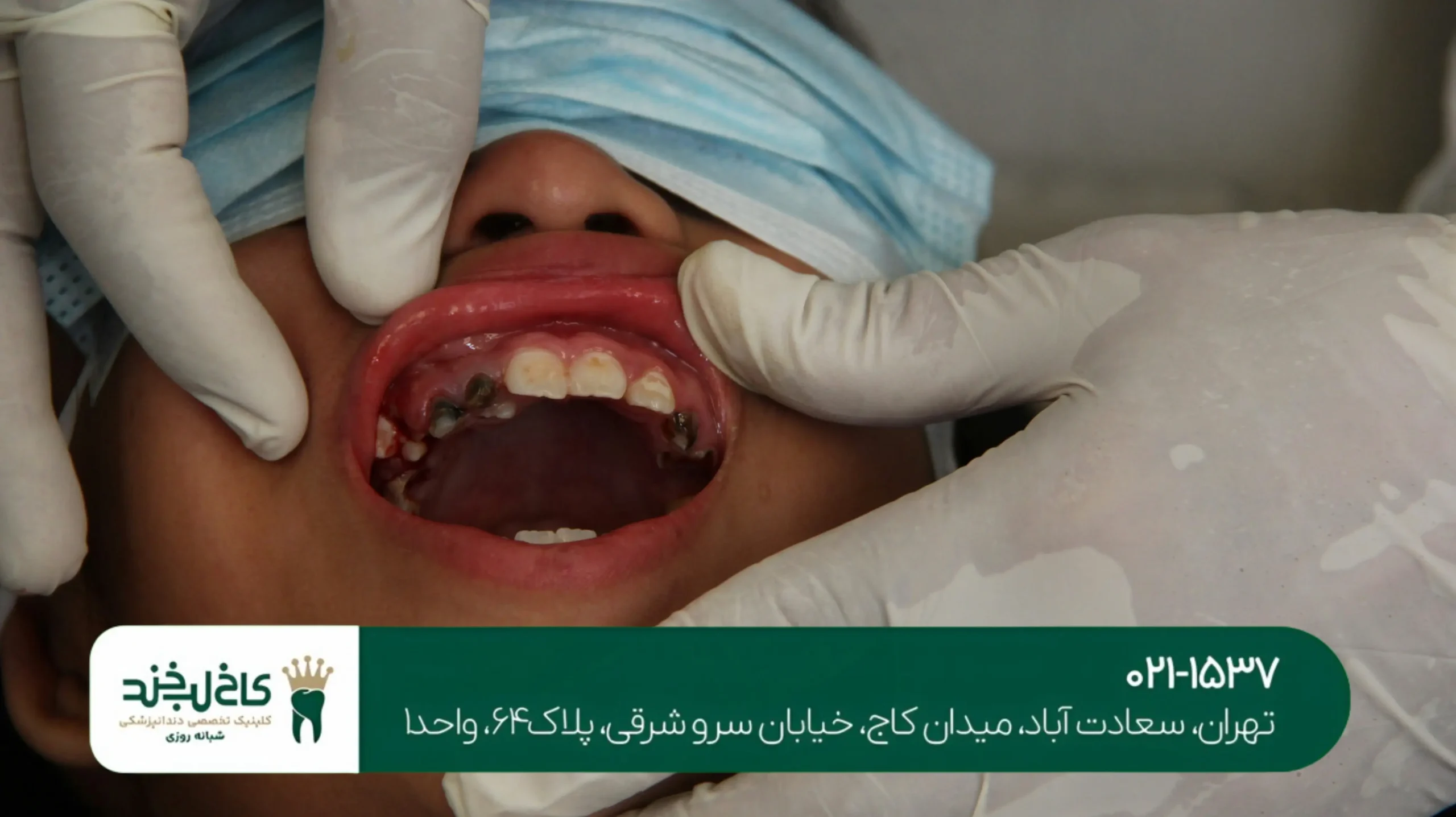 پرکردن دندان بدون درد