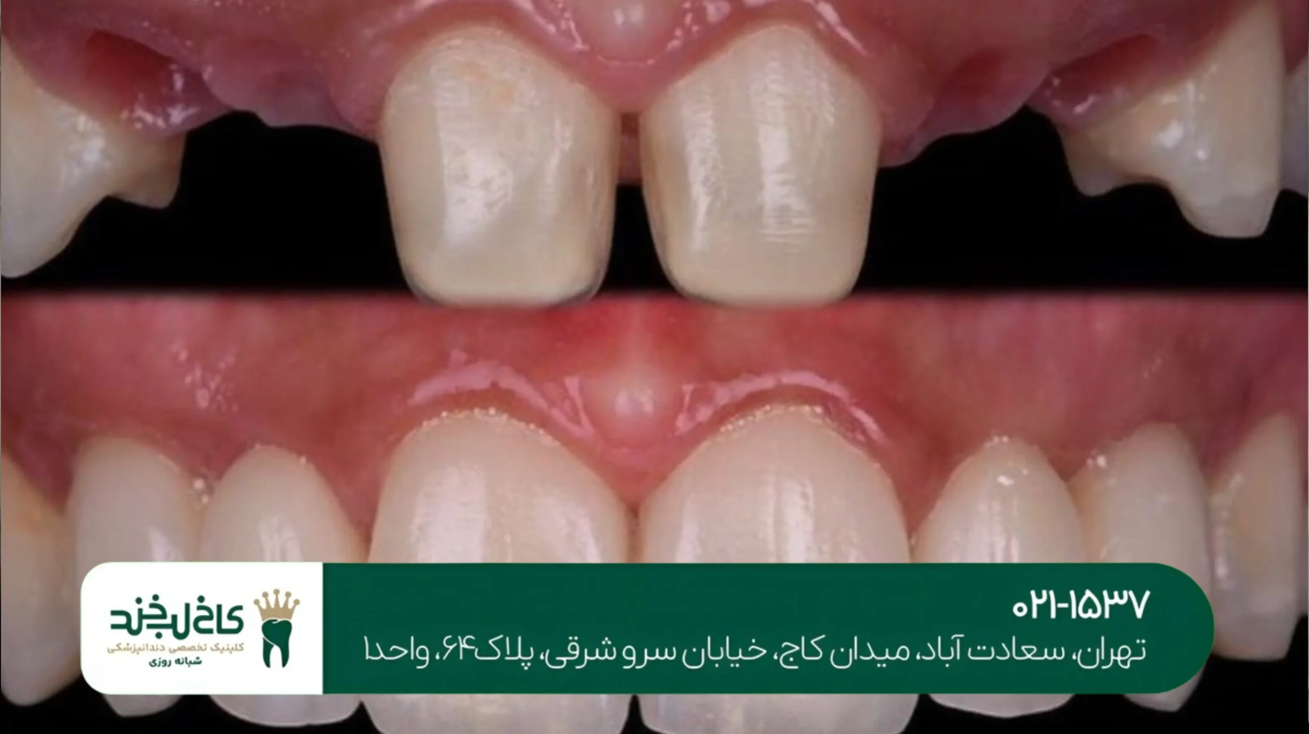 پرکردن دندان بدون درد