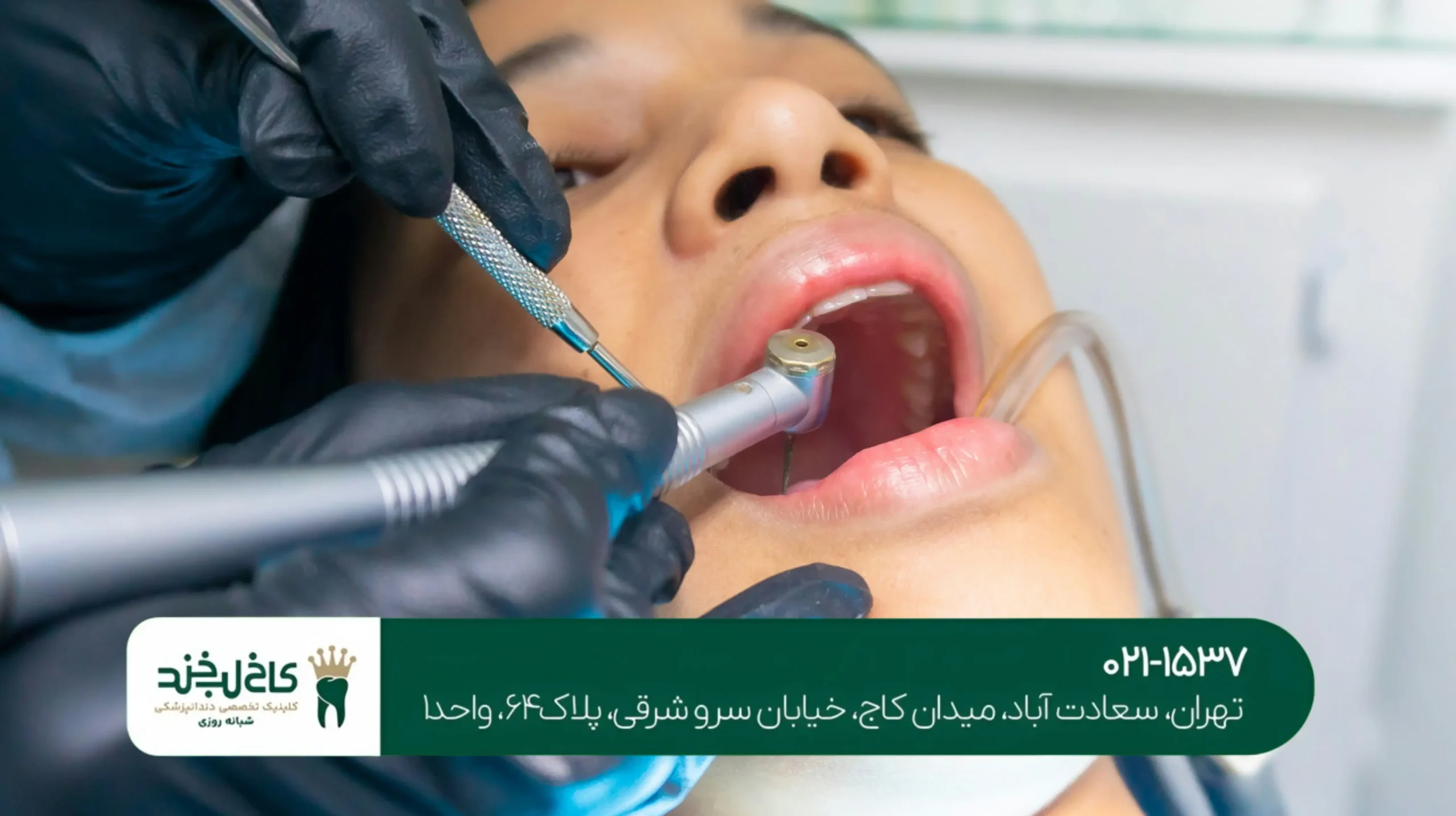 درمان شکستگی دندان جلو