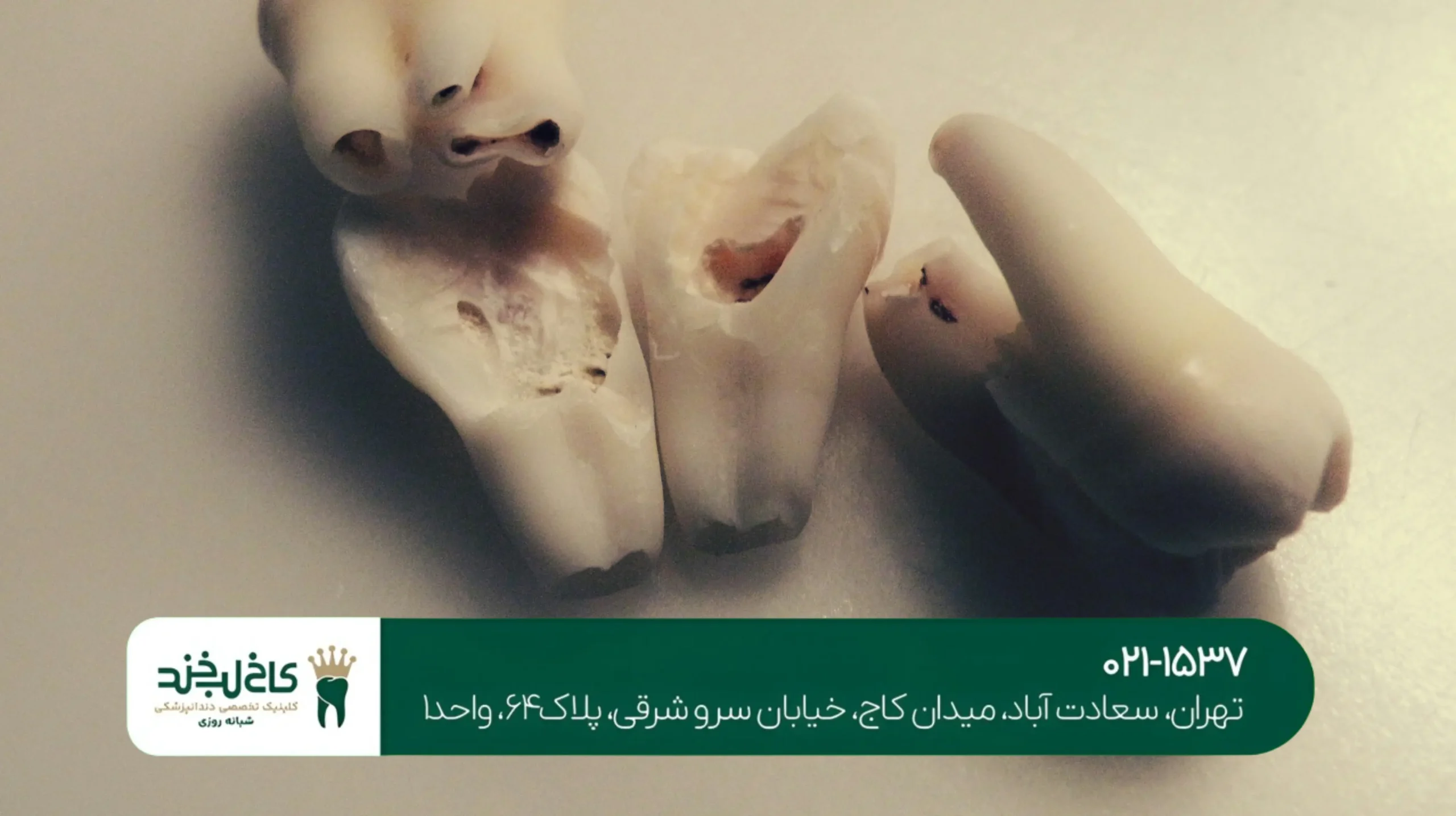 درمان شکستگی دندان جلو