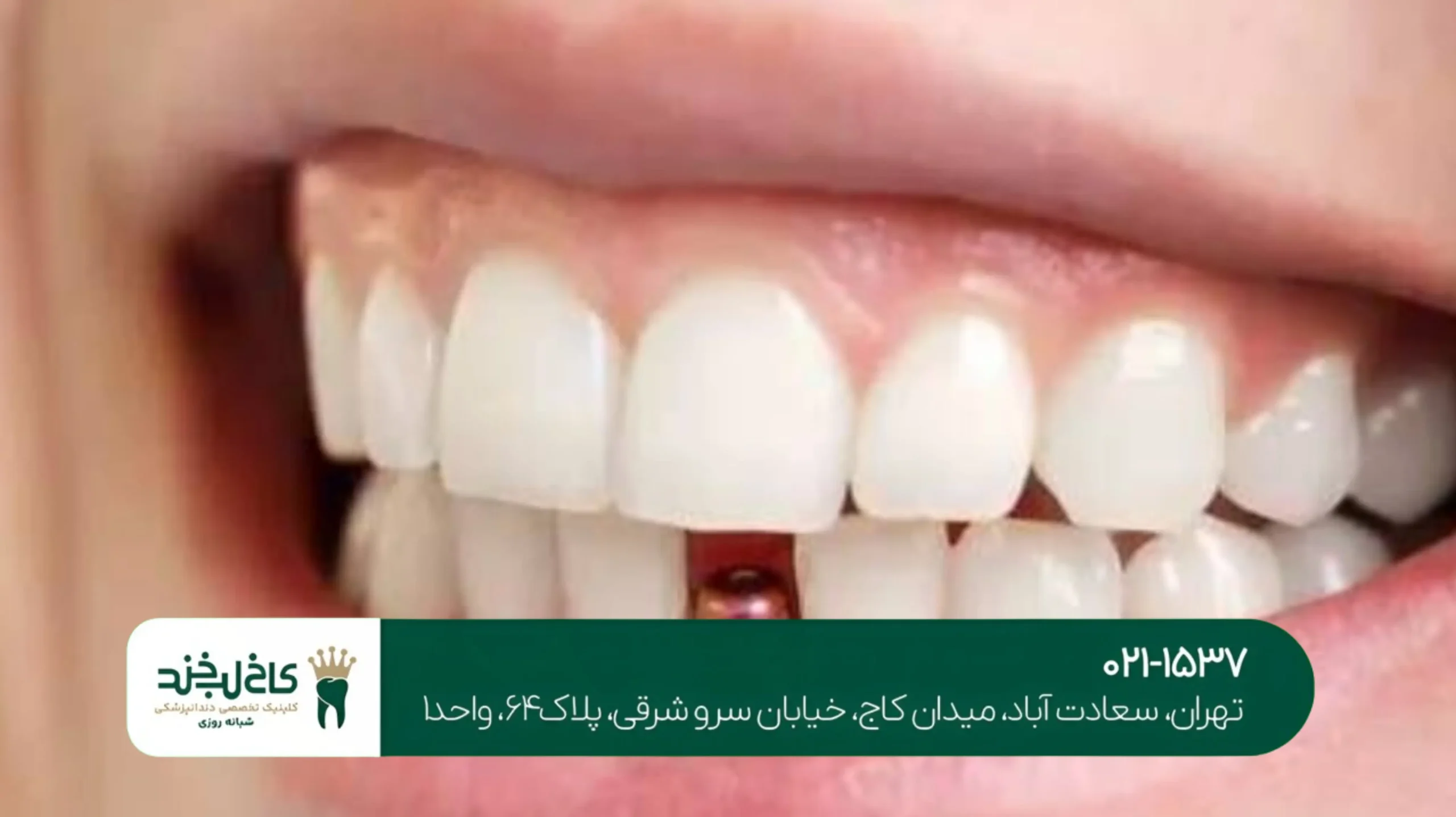 کامپوزیت ونیر طبیعی در تهران