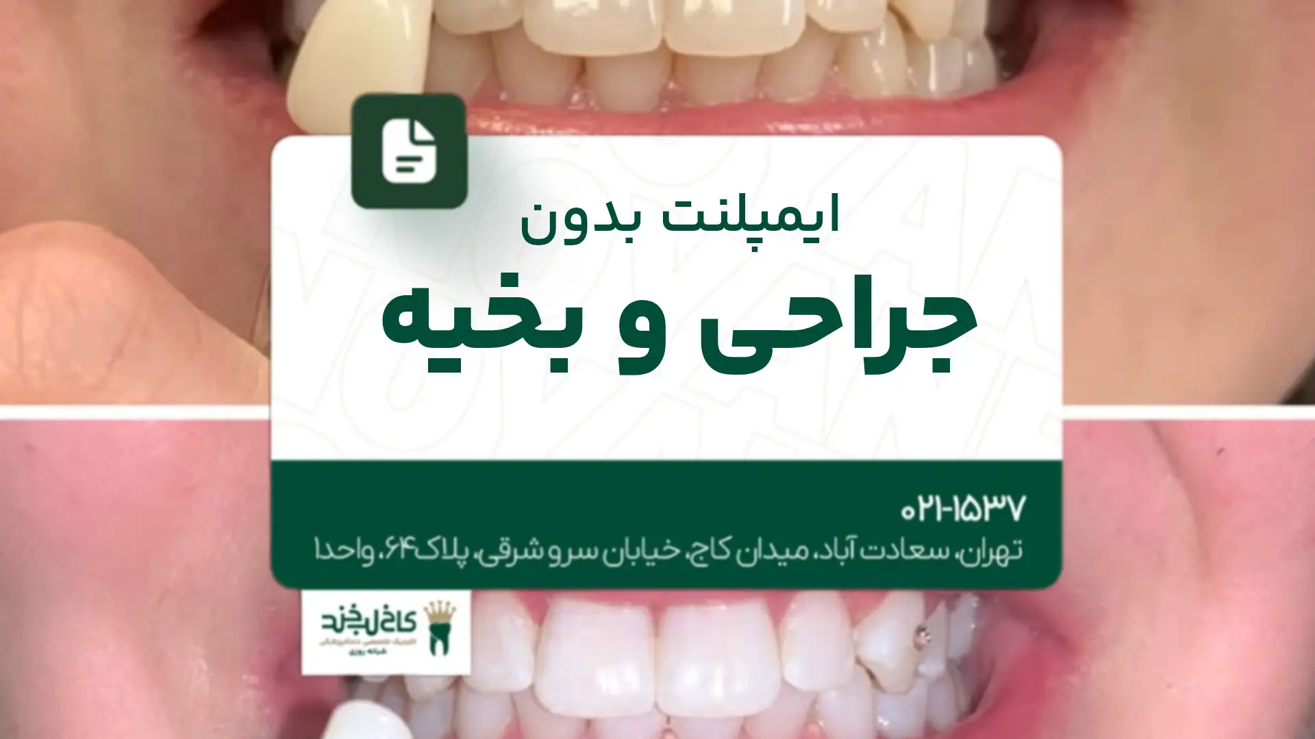 ایمپلنت بدون جراحی و بخیه