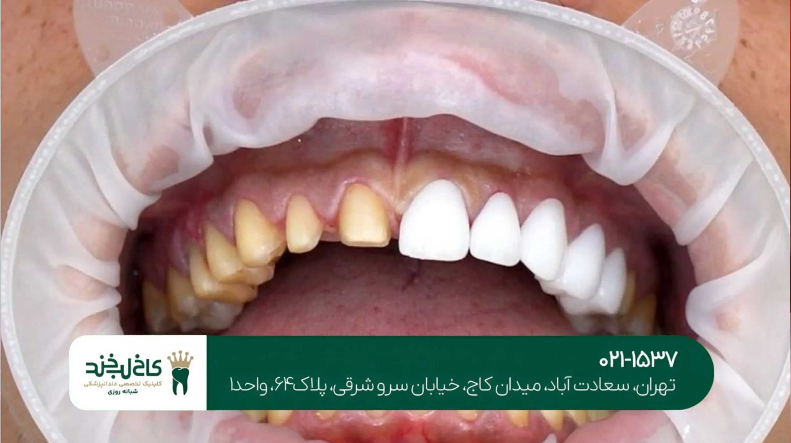 ایمپلنت بدون جراحی و بخیه