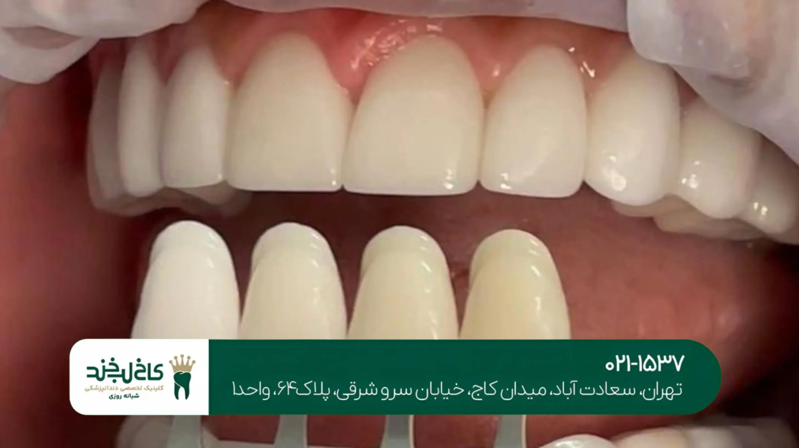 ایمپلنت بدون جراحی و بخیه