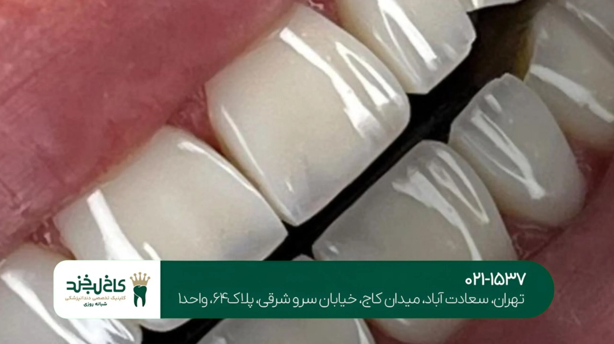 ایمپلنت بدون جراحی و بخیه