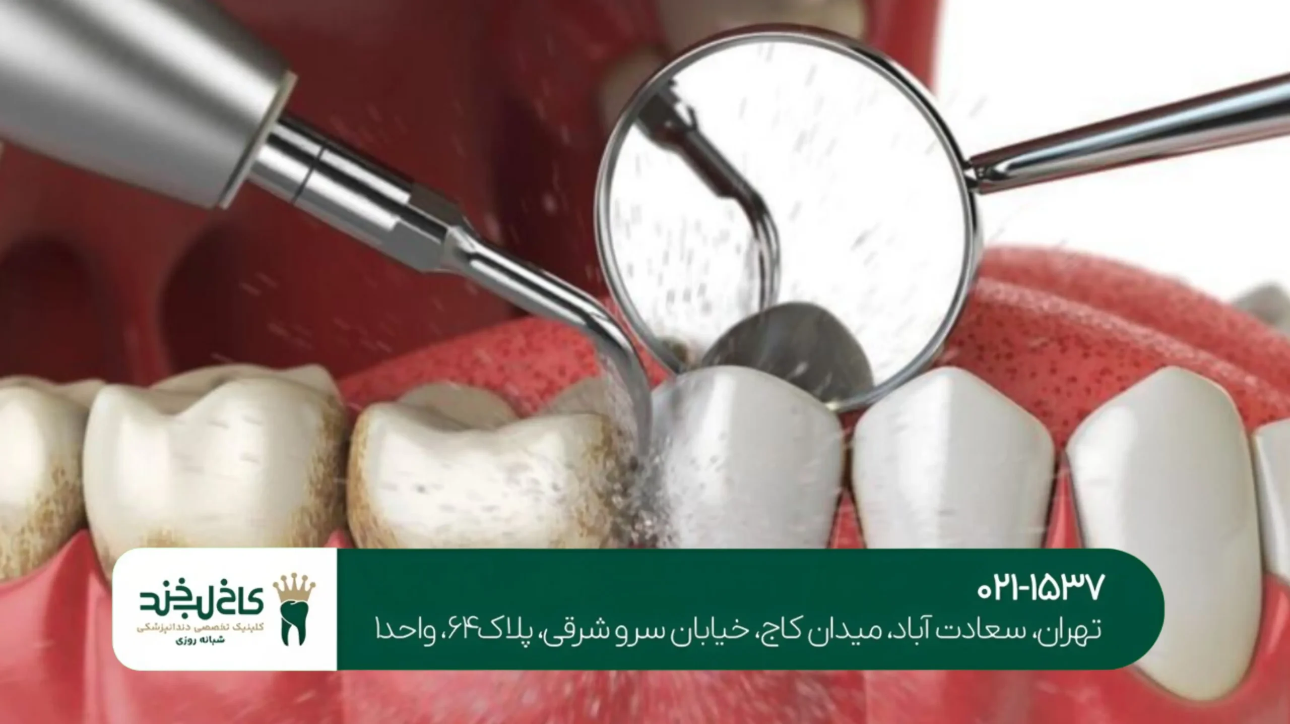 جرمگیری عمیق دندان در شمال تهران