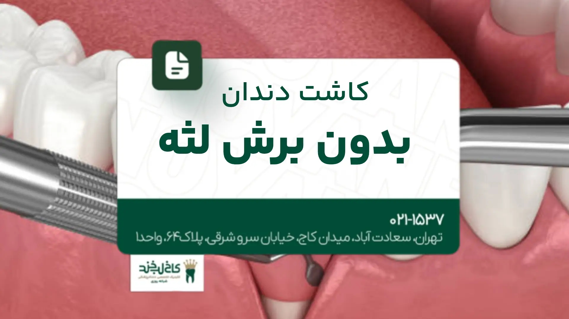 کاشت دندان بدون برش لثه