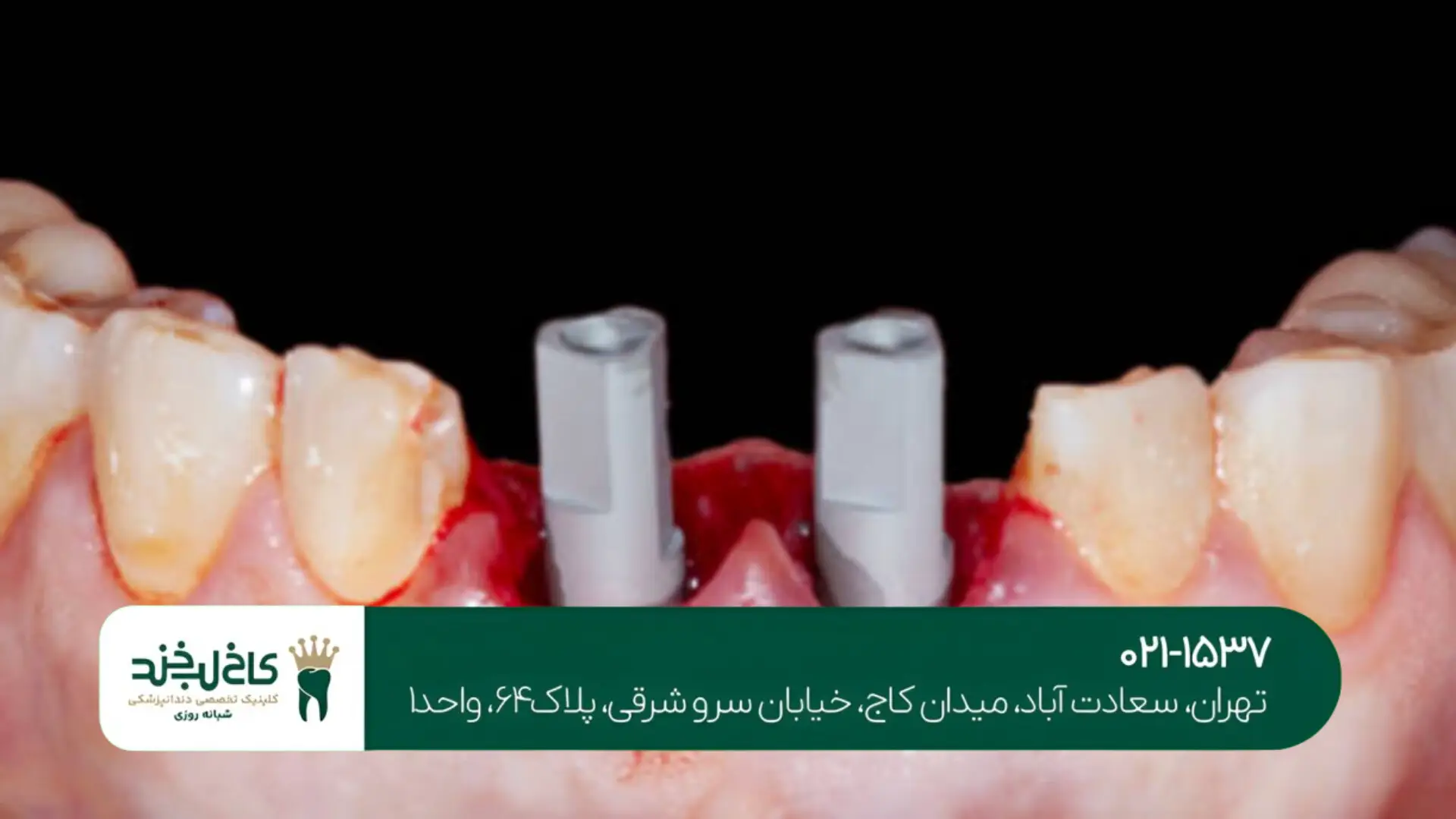 کاشت دندان بدون برش لثه